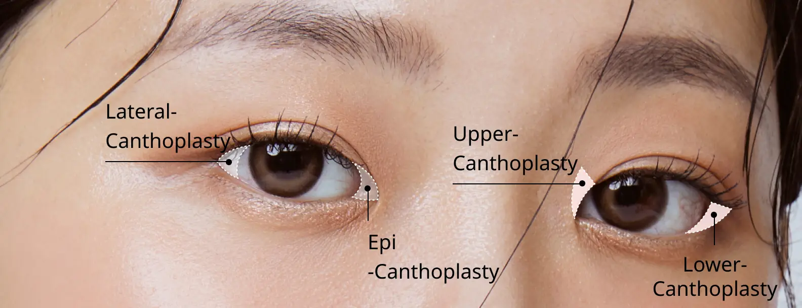 Area Bedah Kantoplasti Mata Besar.