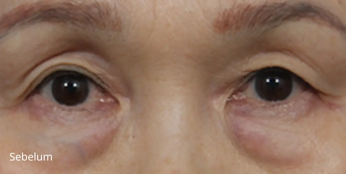 Gambar Sebelum Bedah Blepharoplasty Bawah Aegyo sal untuk Paruh baya MINE.