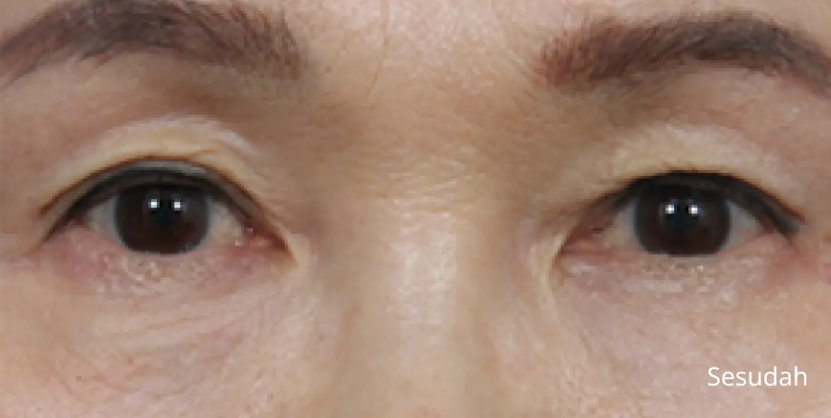 Gambar Sesuda Bedah Blepharoplasty Bawah Aegyo sal untuk Paruh baya MINE.