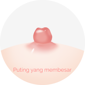 Operasi Puting Yang Membesar.