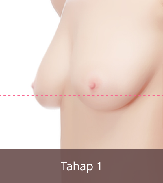 Operasi Payudara Kendur, Gambar Tahap 1.