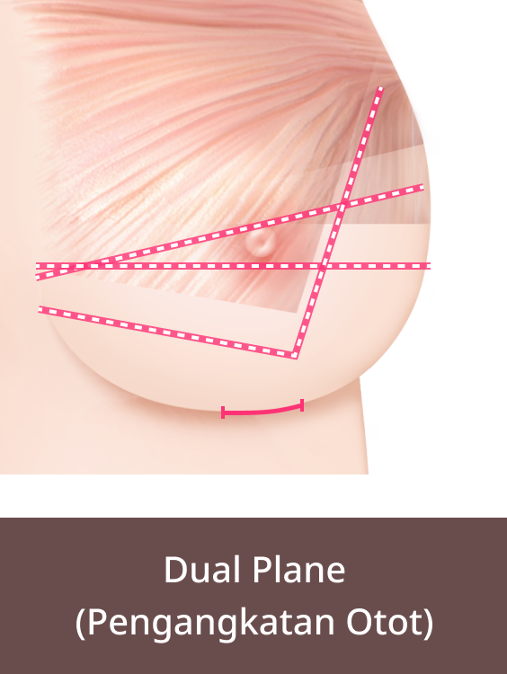 Operasi Payudara Kendur Metode Sayatan Dual Plane,Gambar 3.