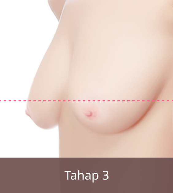 Operasi Payudara Kendur, Gambar Tahap 3.