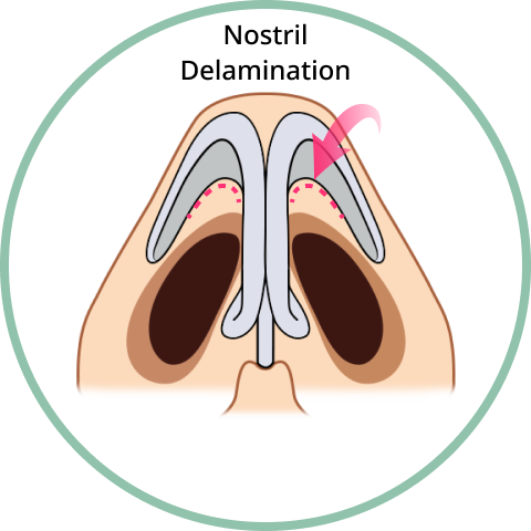 nostril delamination.
