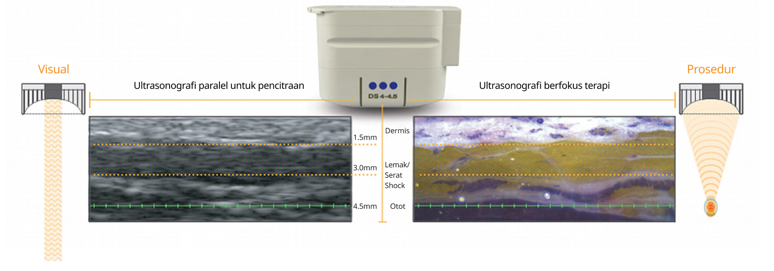 Laser Ulthera.