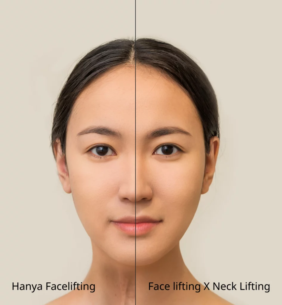 perbandingan facelifting biasa dan face lifting + neck lifting