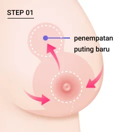 Langkah 1 sayatan pengecilan payudara berbentuk lollipop.