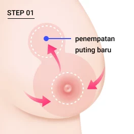 Langkah 1 sayatan pengecilan payudara.