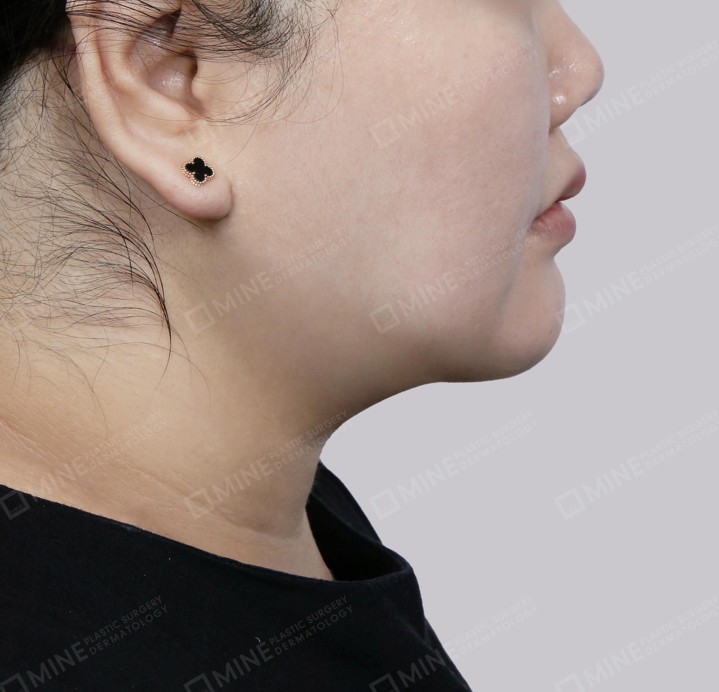 Lifting Leher Mini-Samping-Sesudah