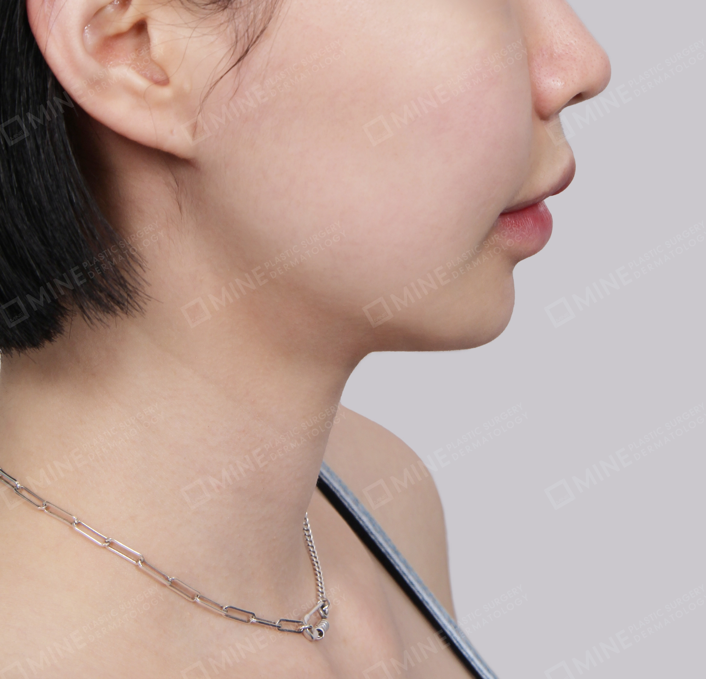 Lifting Leher Mini-Samping-Sesudah