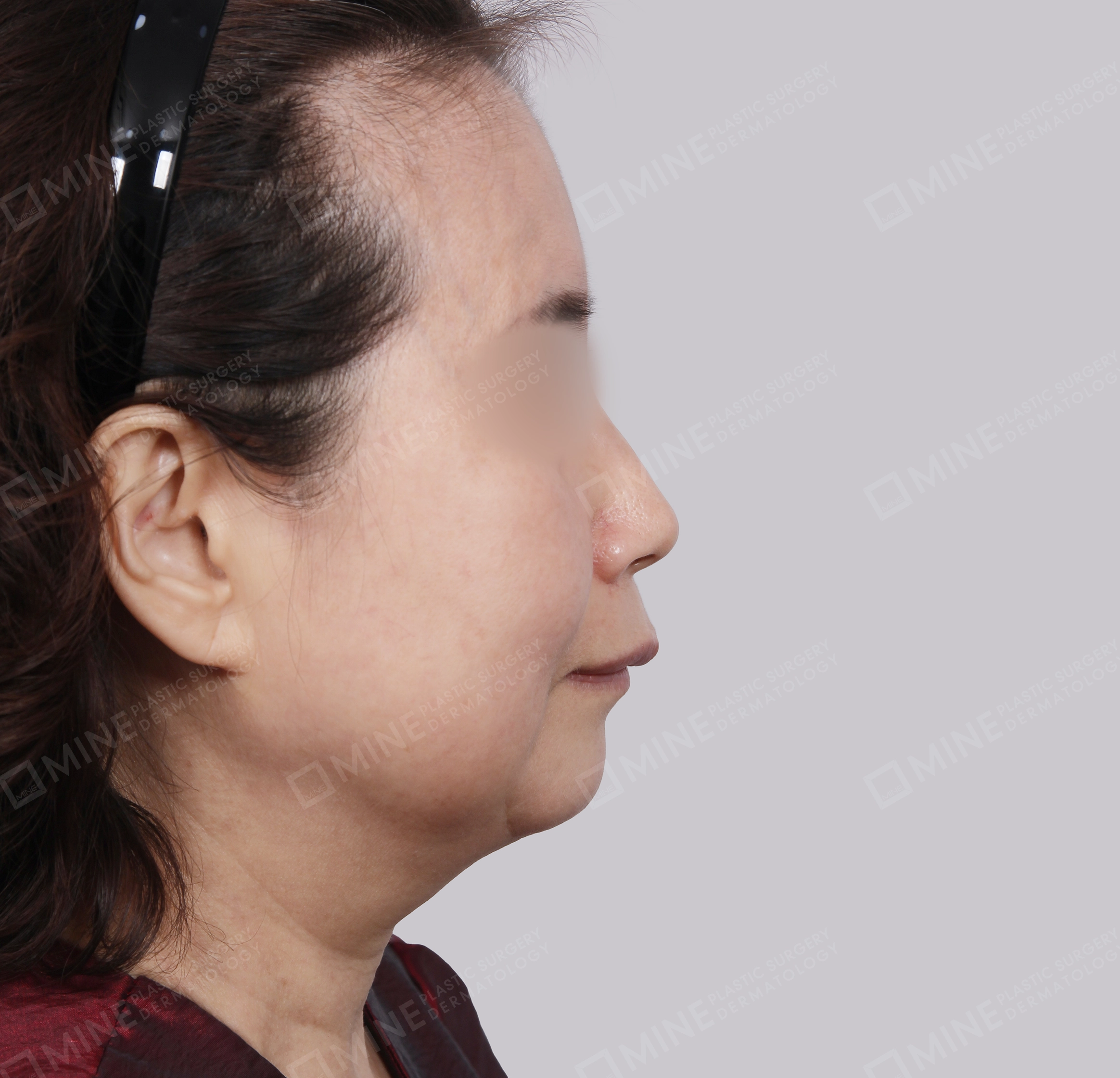 Lifting Wajah SMAS-Samping-Sebelum