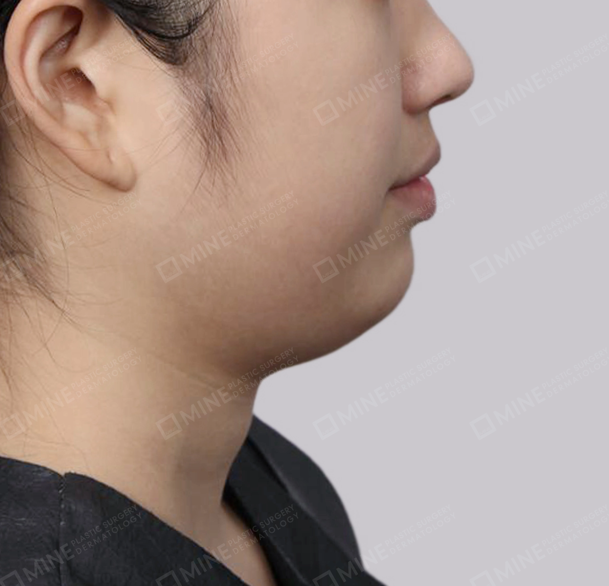 Vlimming (Dagu Ganda)-Samping-Sebelum