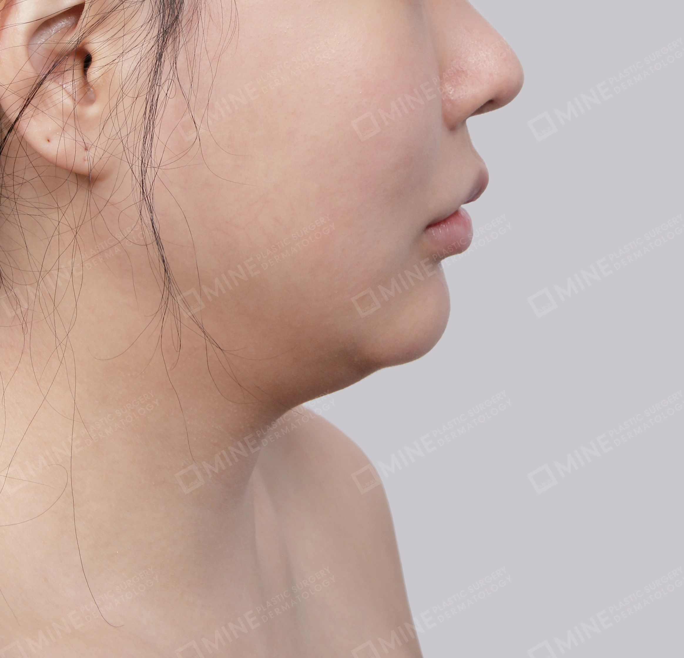 Vlimming (Dagu Ganda)-Samping-Sebelum