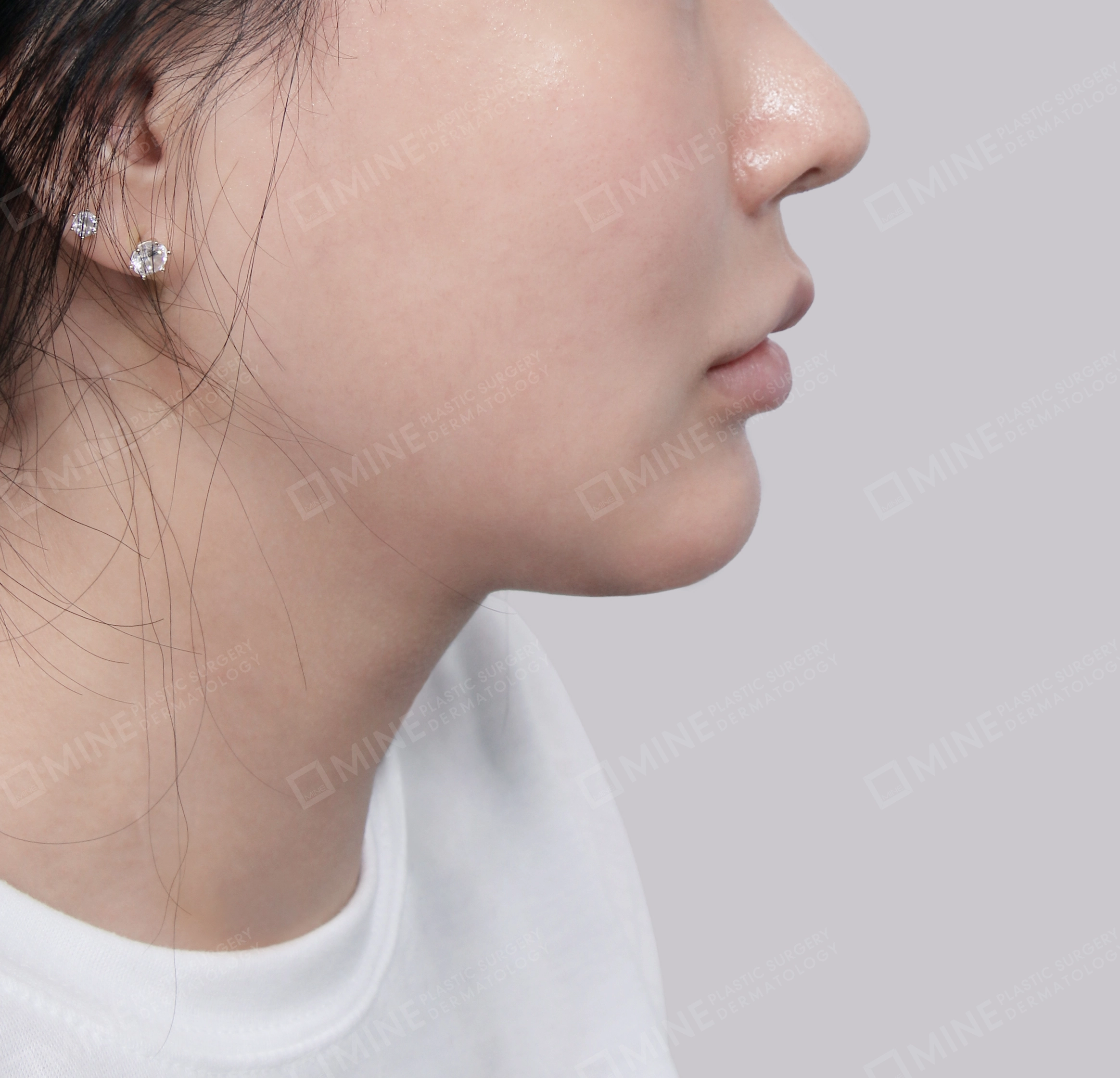 Vlimming (Dagu Ganda)-Samping-Sesudah