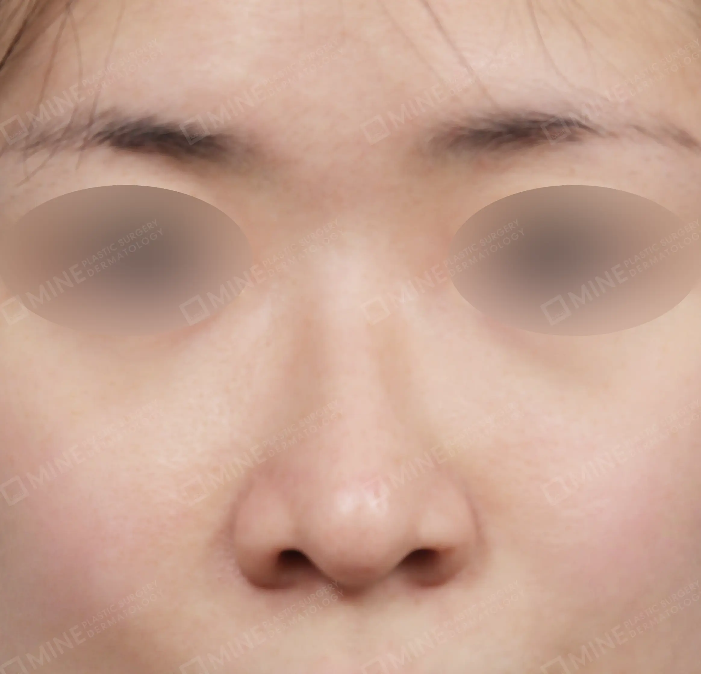 Hidung Punuk + Batang dan Ujung Hidung + Pengecilan Lubang Hidung + Pengurangan Ujung Hidung-Depan-Sebelum