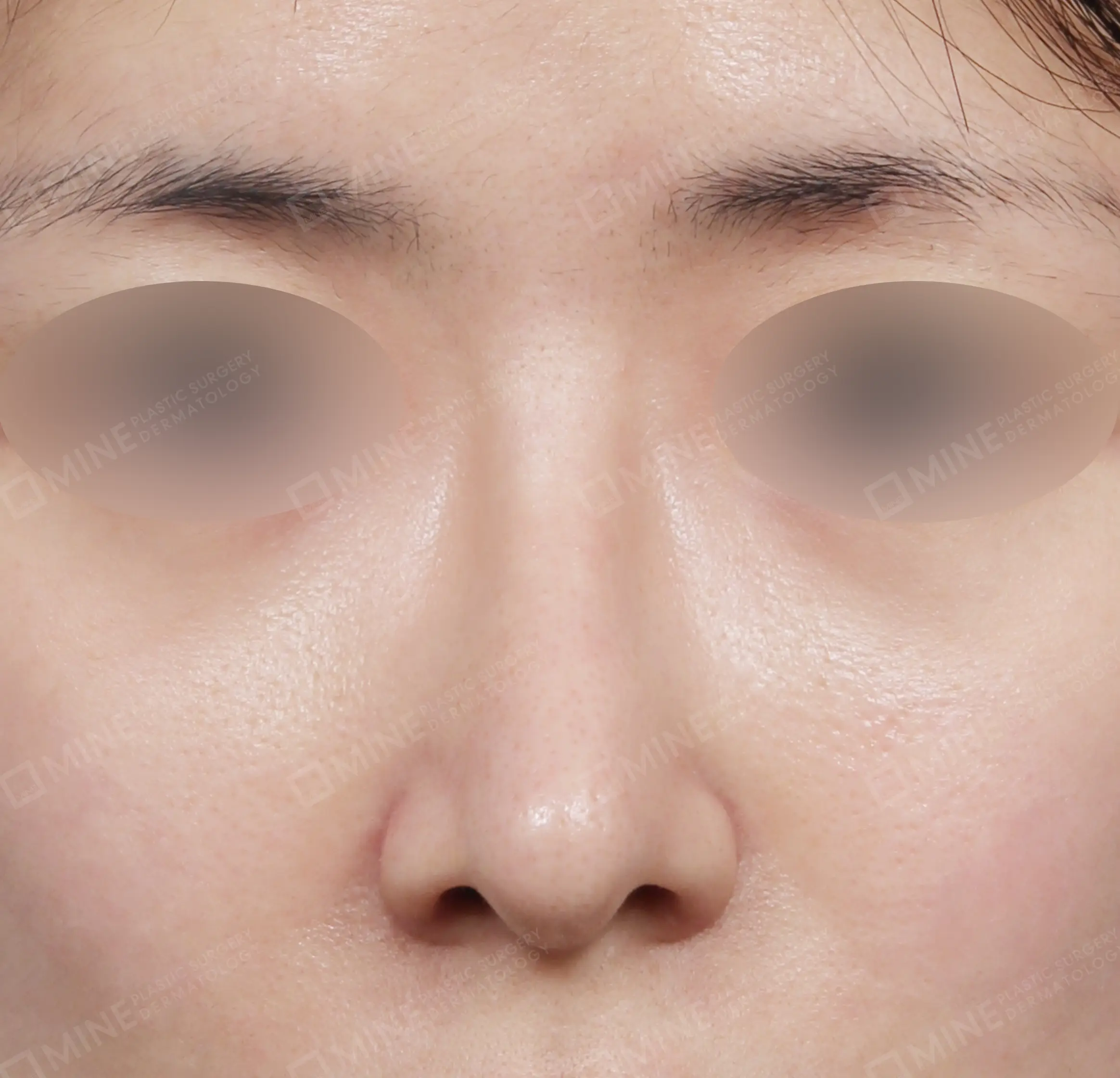 Hidung Punuk + Batang dan Ujung Hidung + Pengecilan Lubang Hidung + Pengurangan Ujung Hidung-Depan-Sesudah