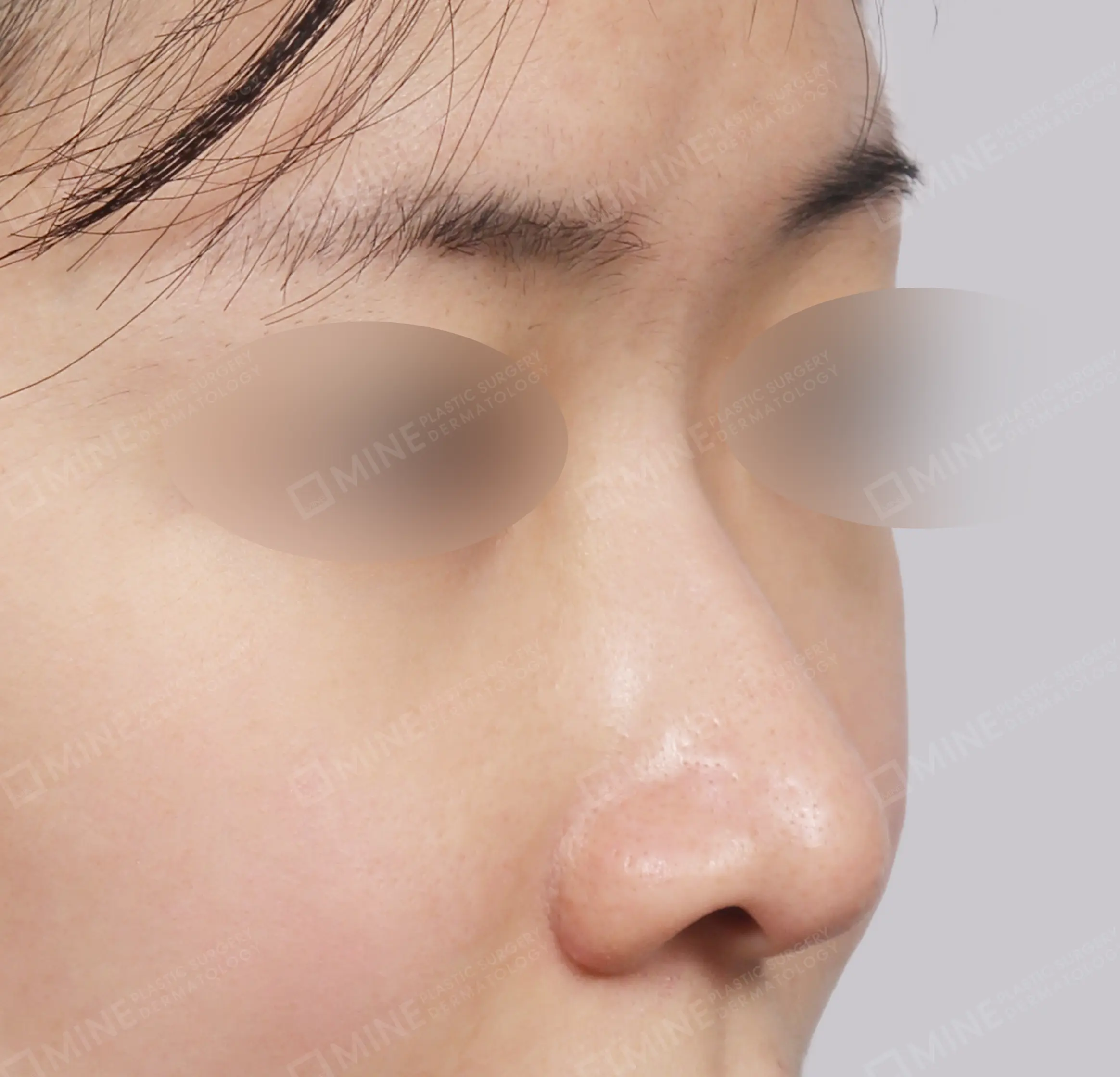 Hidung Punuk + Batang dan Ujung Hidung + Pengecilan Lubang Hidung + Pengurangan Ujung Hidung-45 Derajat-Sebelum