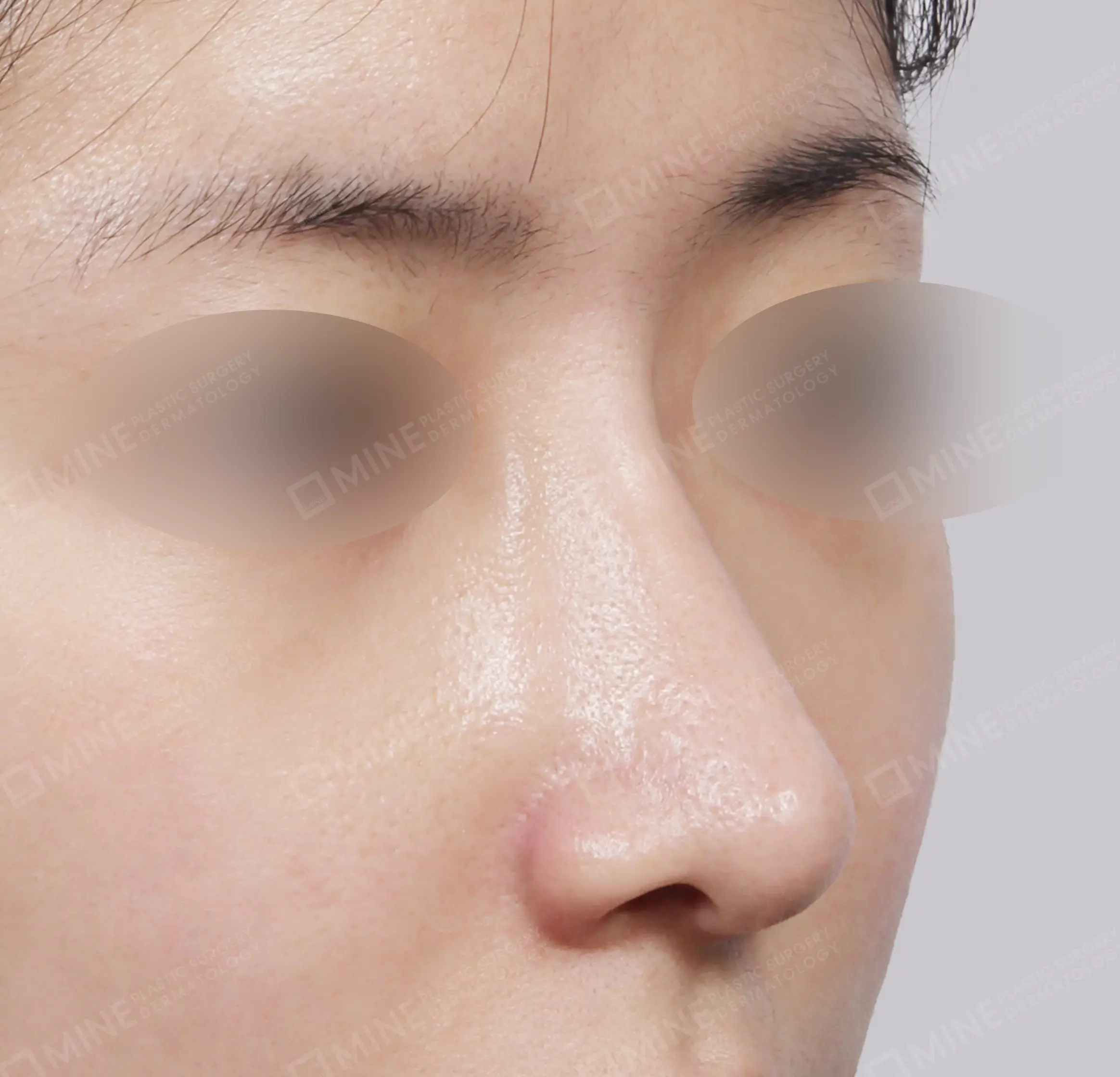 Hidung Punuk + Batang dan Ujung Hidung + Pengecilan Lubang Hidung + Pengurangan Ujung Hidung-45 Derajat-Sesudah