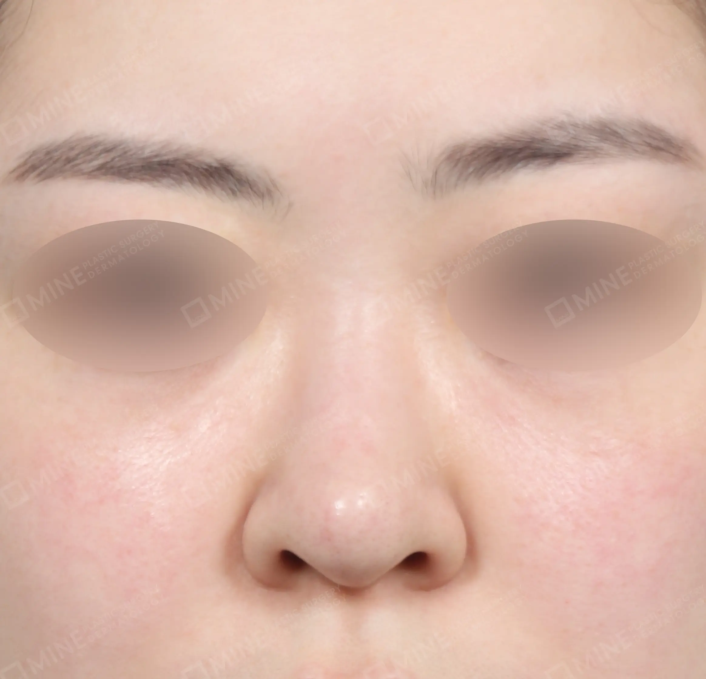 Revisi Operasi Hidung-Depan-Sebelum