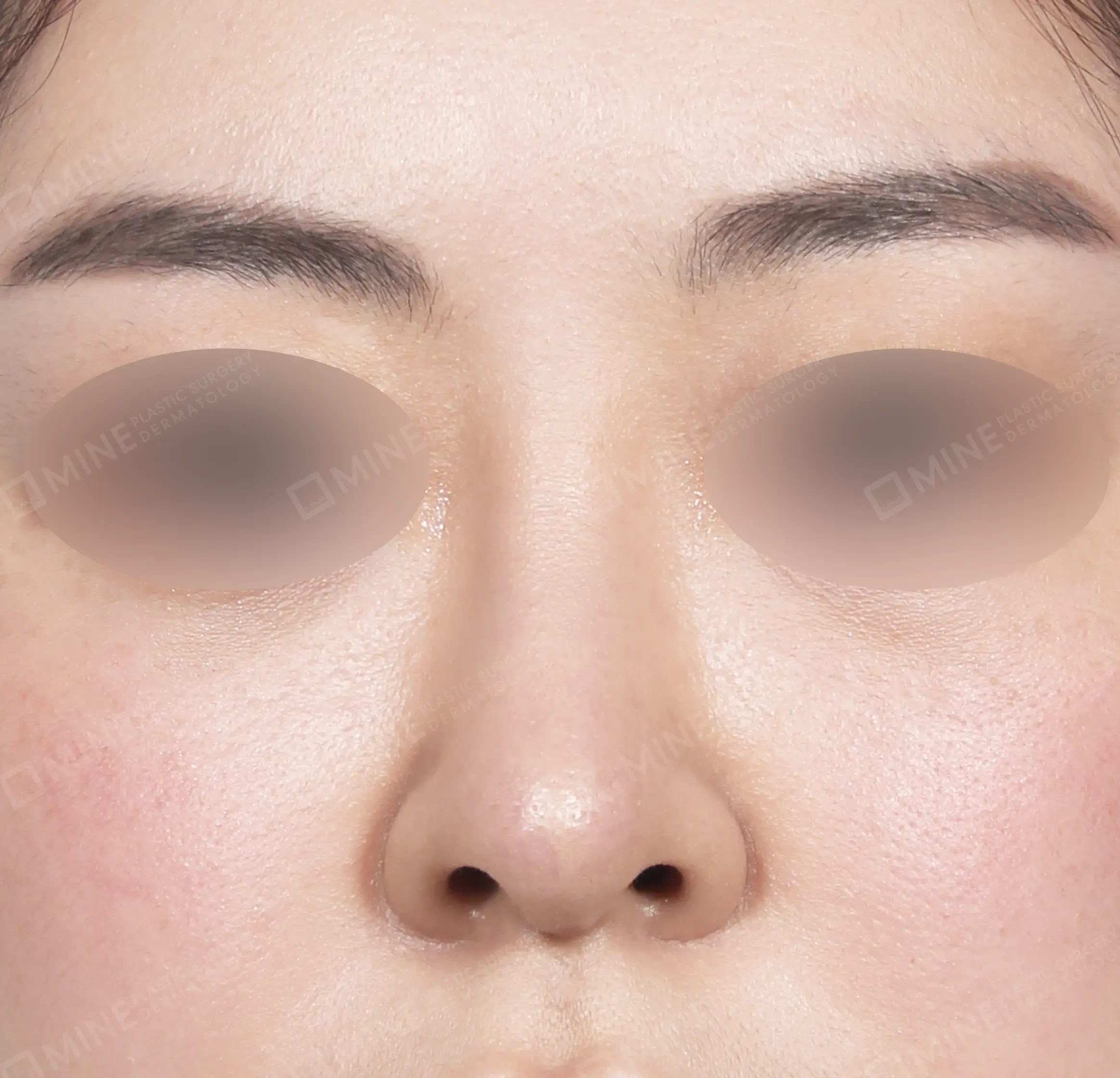 Revisi Operasi Hidung-Depan-Sesudah