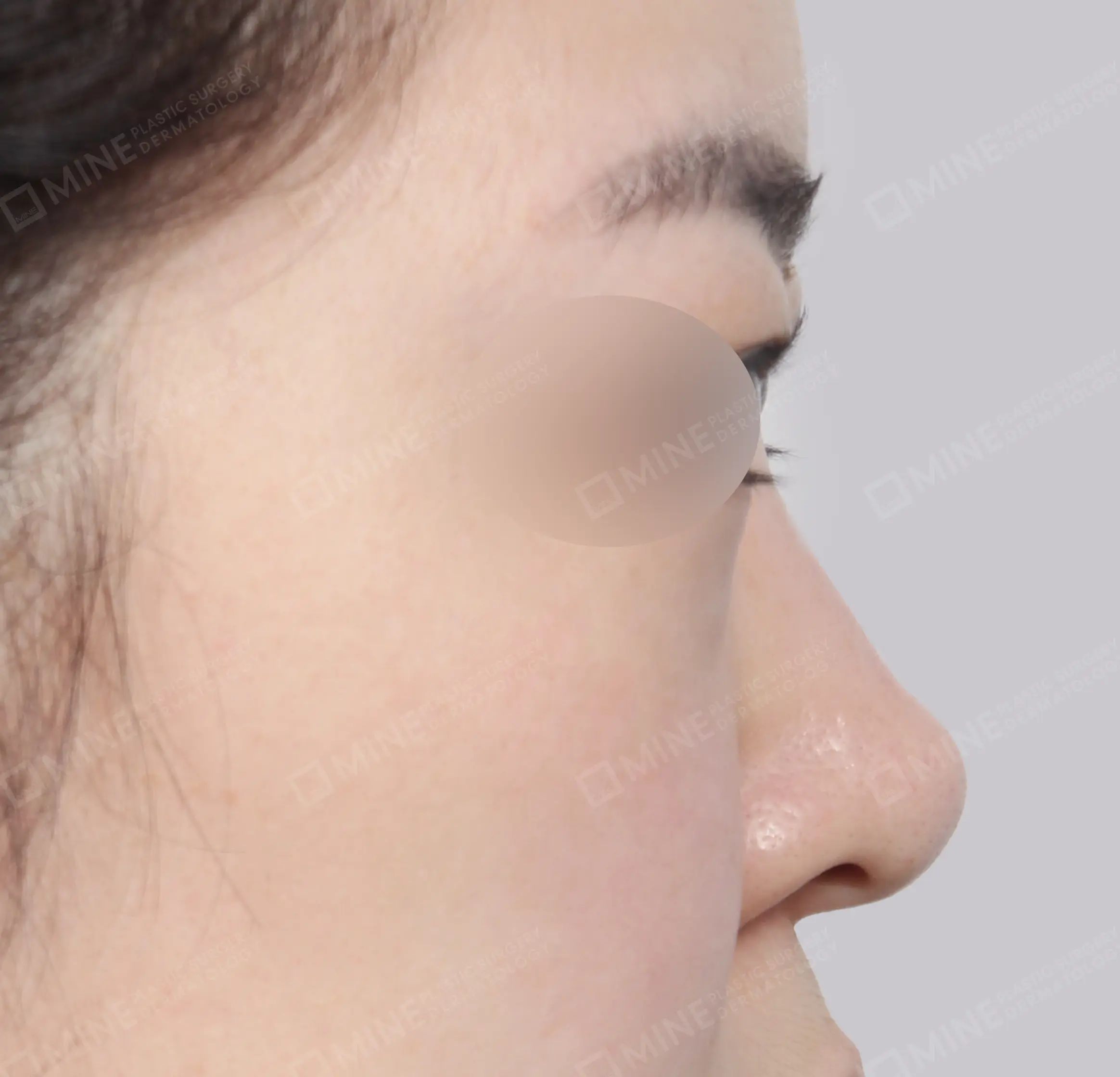 Revisi Operasi Hidung-Samping-Sebelum