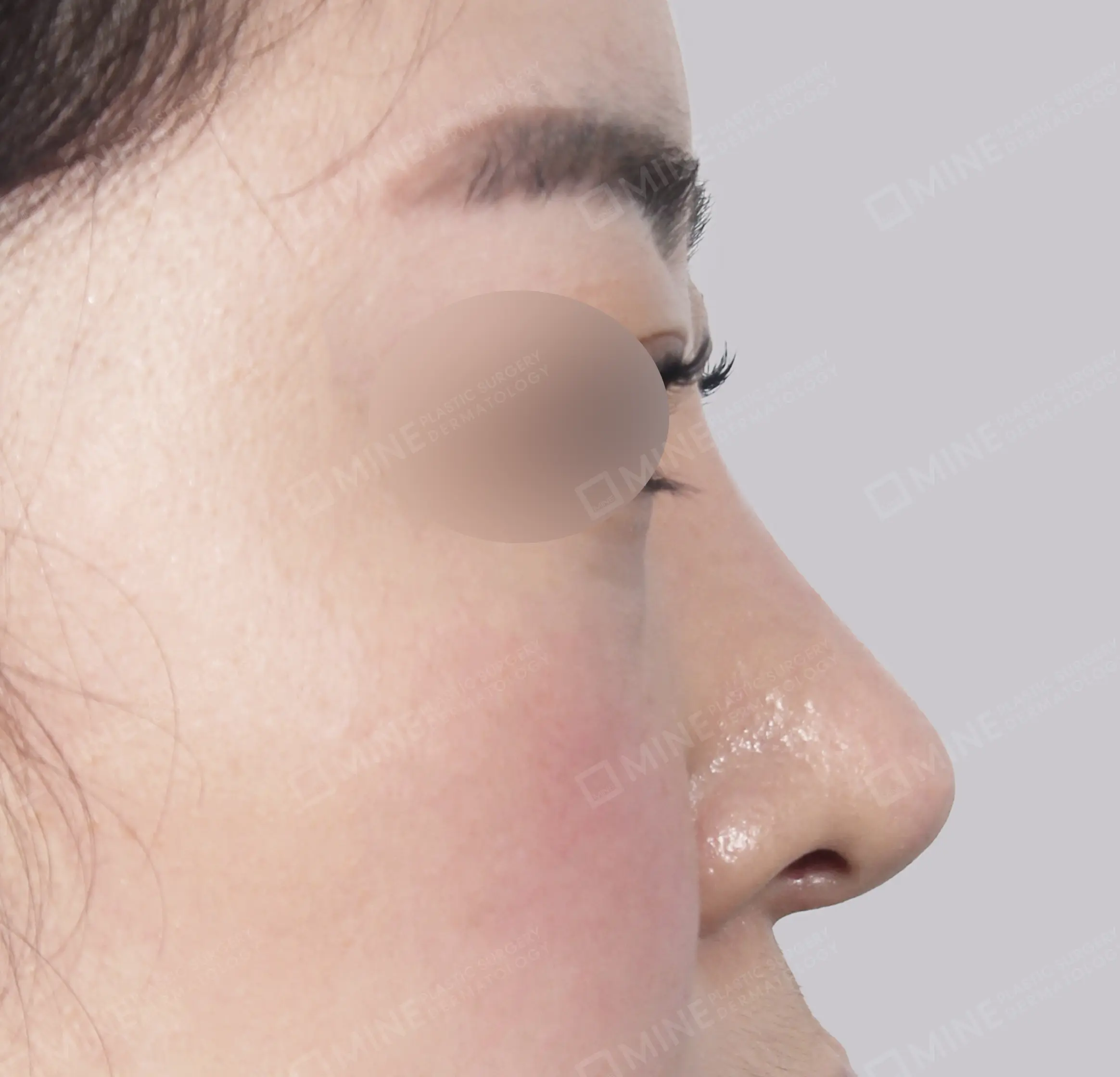 Revisi Operasi Hidung-Samping-Sesudah