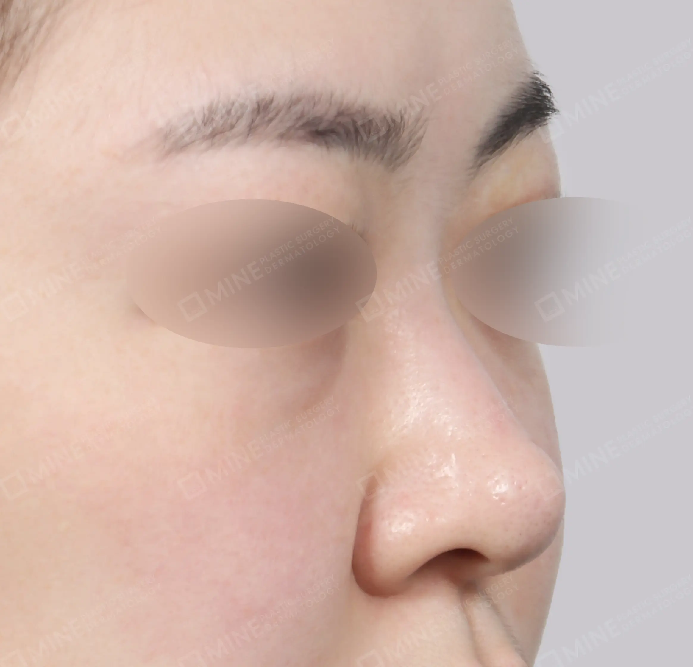 Revisi Operasi Hidung-45 Derajat-Sebelum