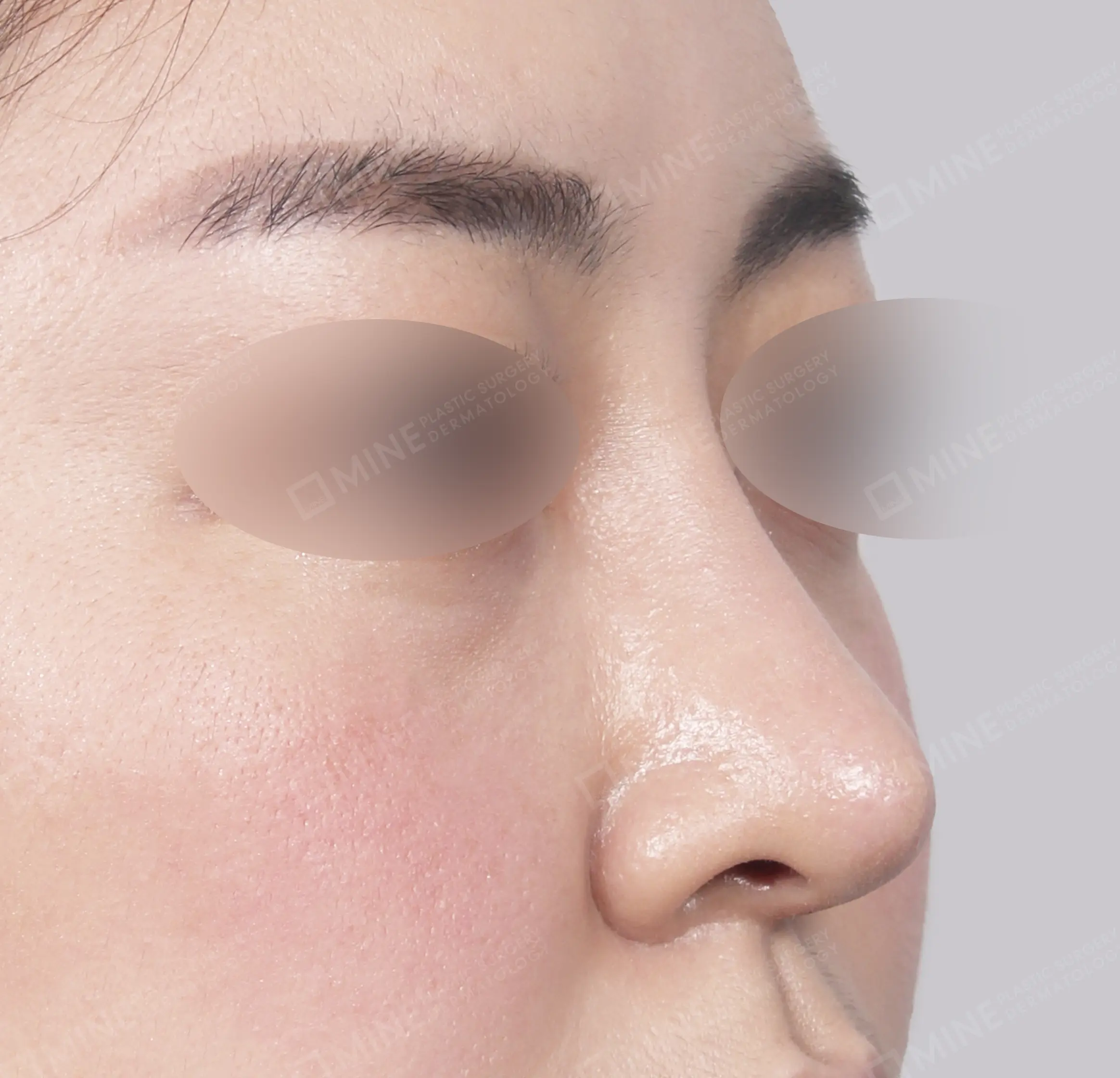 Revisi Operasi Hidung-45 Derajat-Sesudah