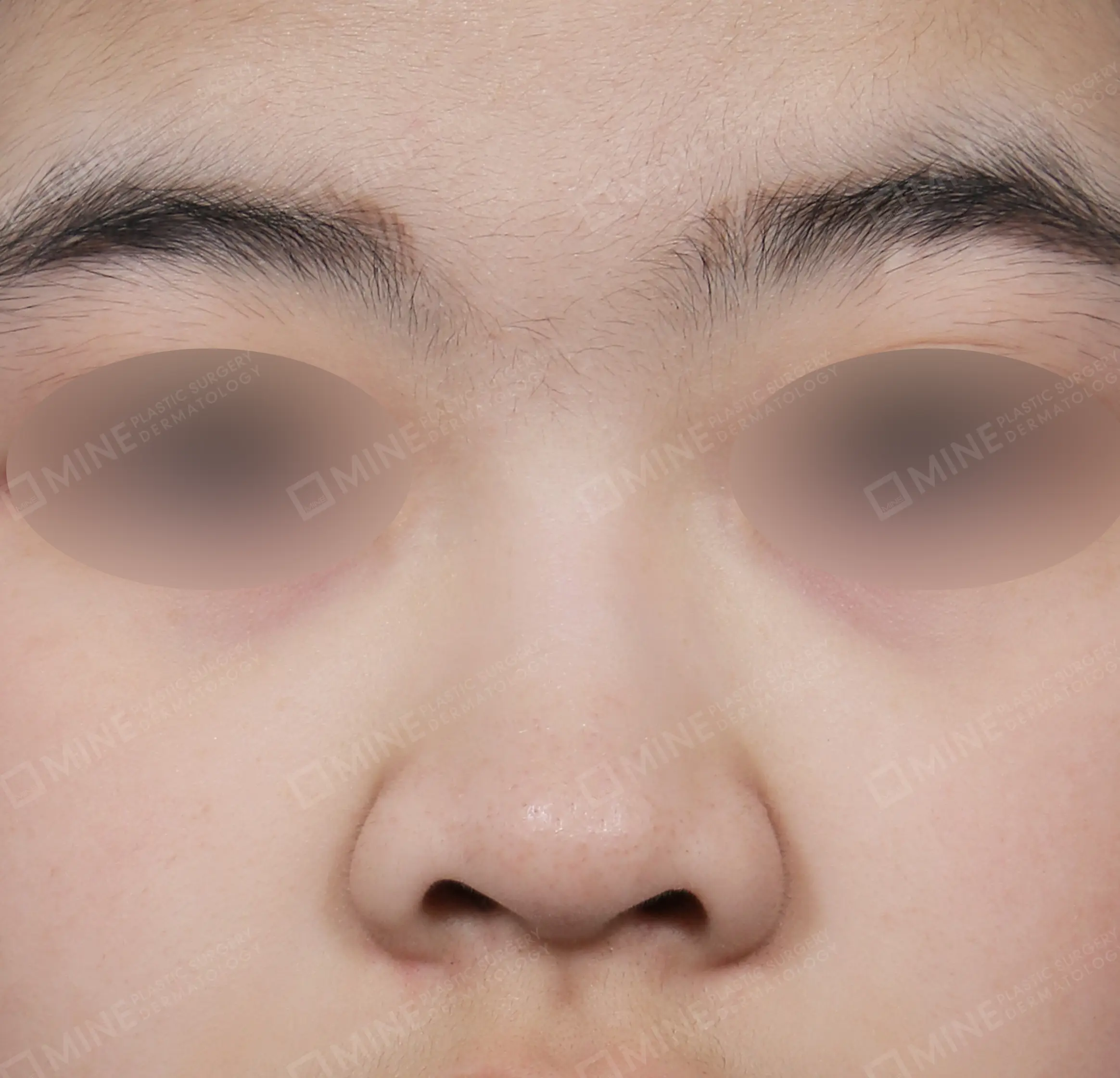Batang Hidung + Pemanjangan Septum Hidung + Pengurangan Ujung Hidung + Pengecilan Lubang Hidung-Depan-Sebelum