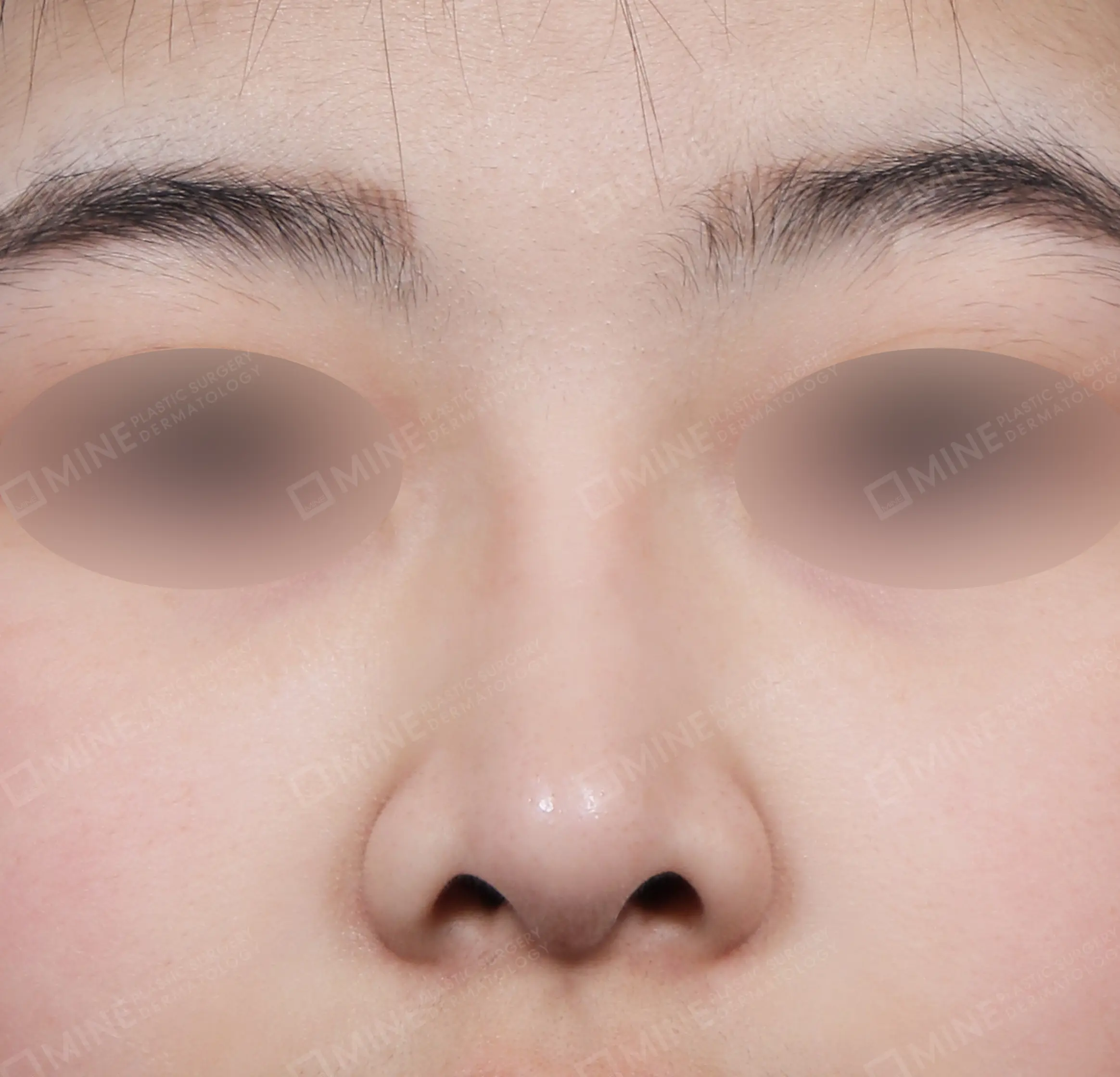 Batang Hidung + Pemanjangan Septum Hidung + Pengurangan Ujung Hidung + Pengecilan Lubang Hidung-Depan-Sesudah