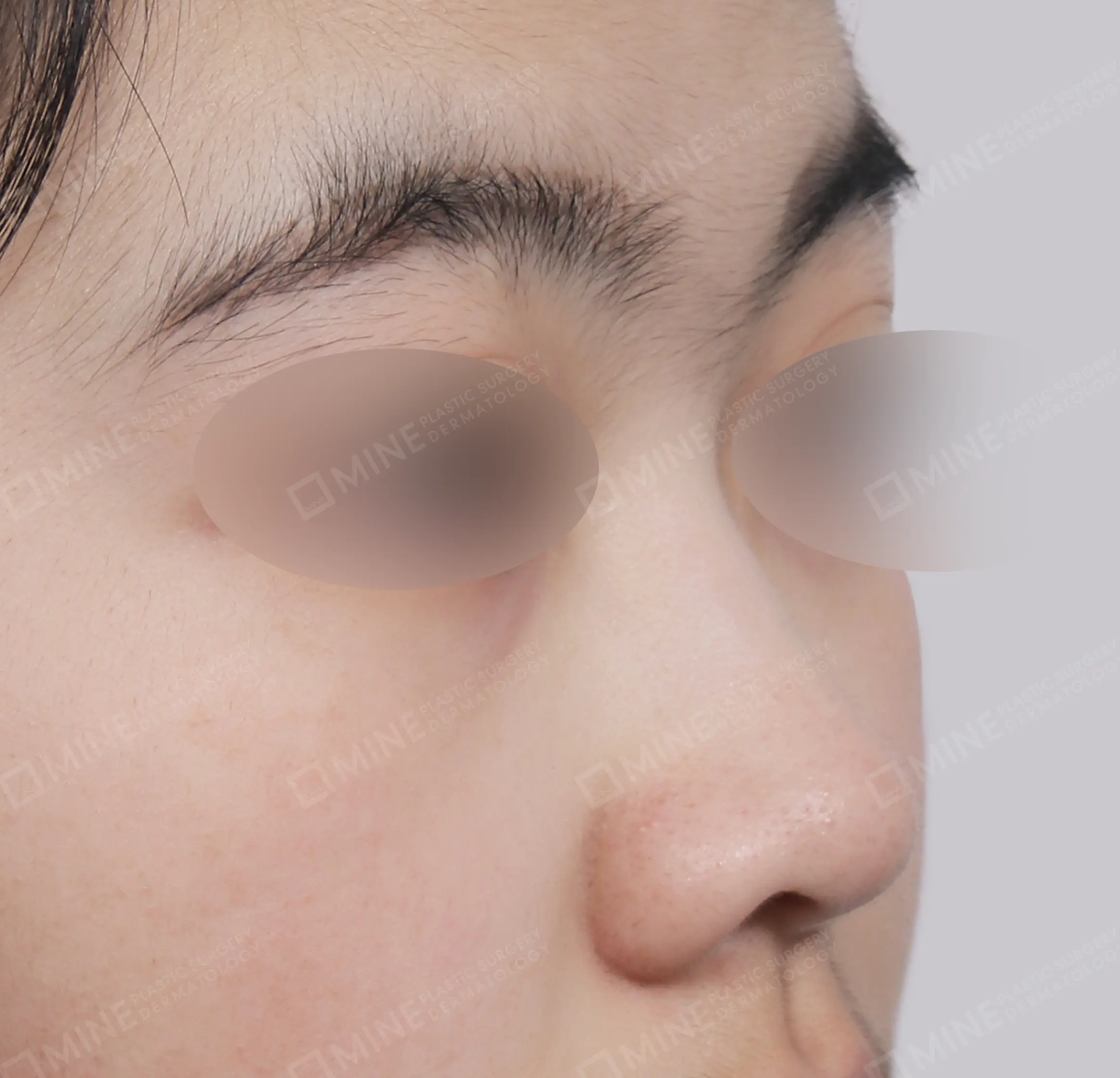 Batang Hidung + Pemanjangan Septum Hidung + Pengurangan Ujung Hidung + Pengecilan Lubang Hidung-45 Derajat-Sebelum