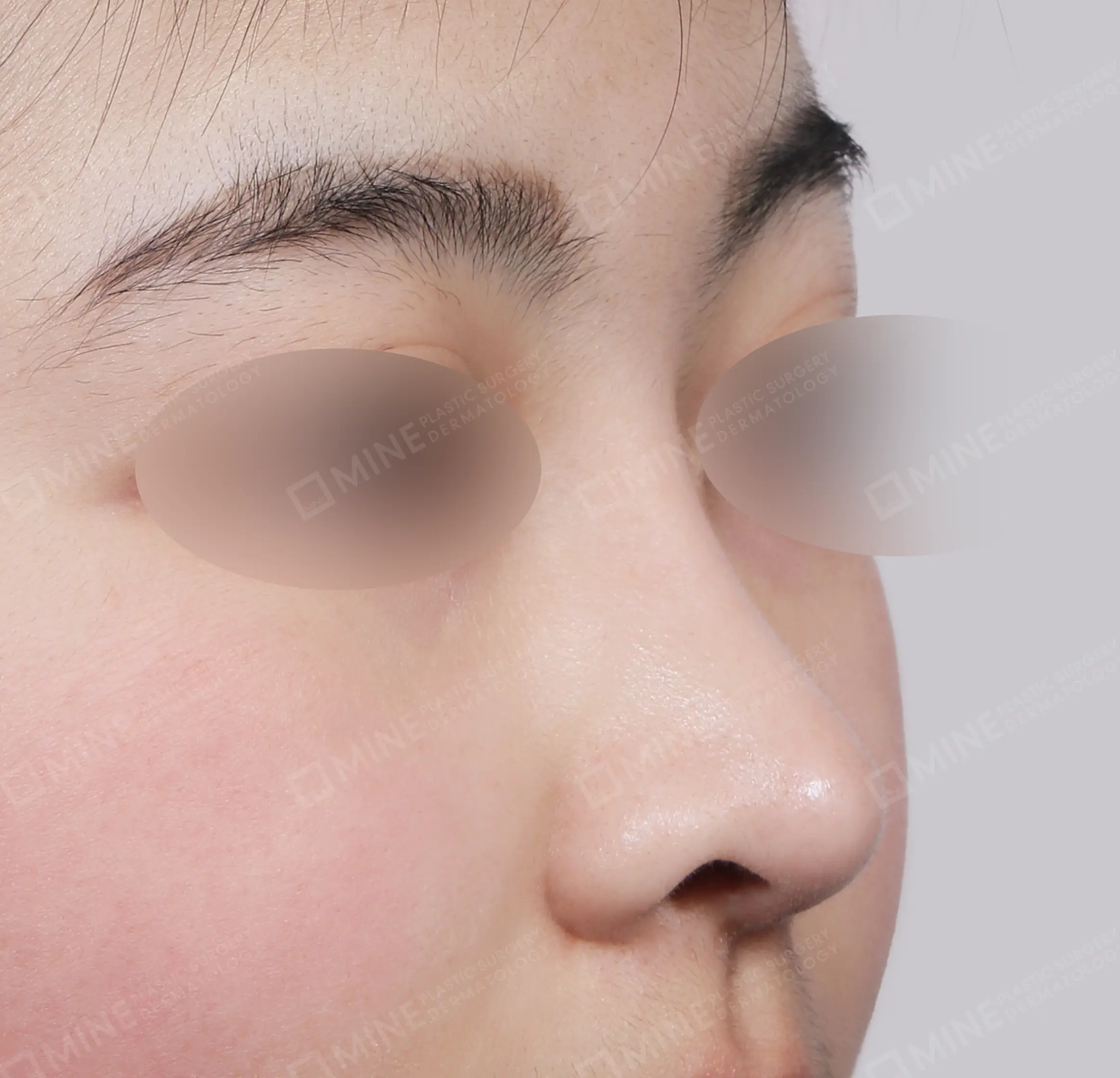 Batang Hidung + Pemanjangan Septum Hidung + Pengurangan Ujung Hidung + Pengecilan Lubang Hidung-45 Derajat-Sesudah