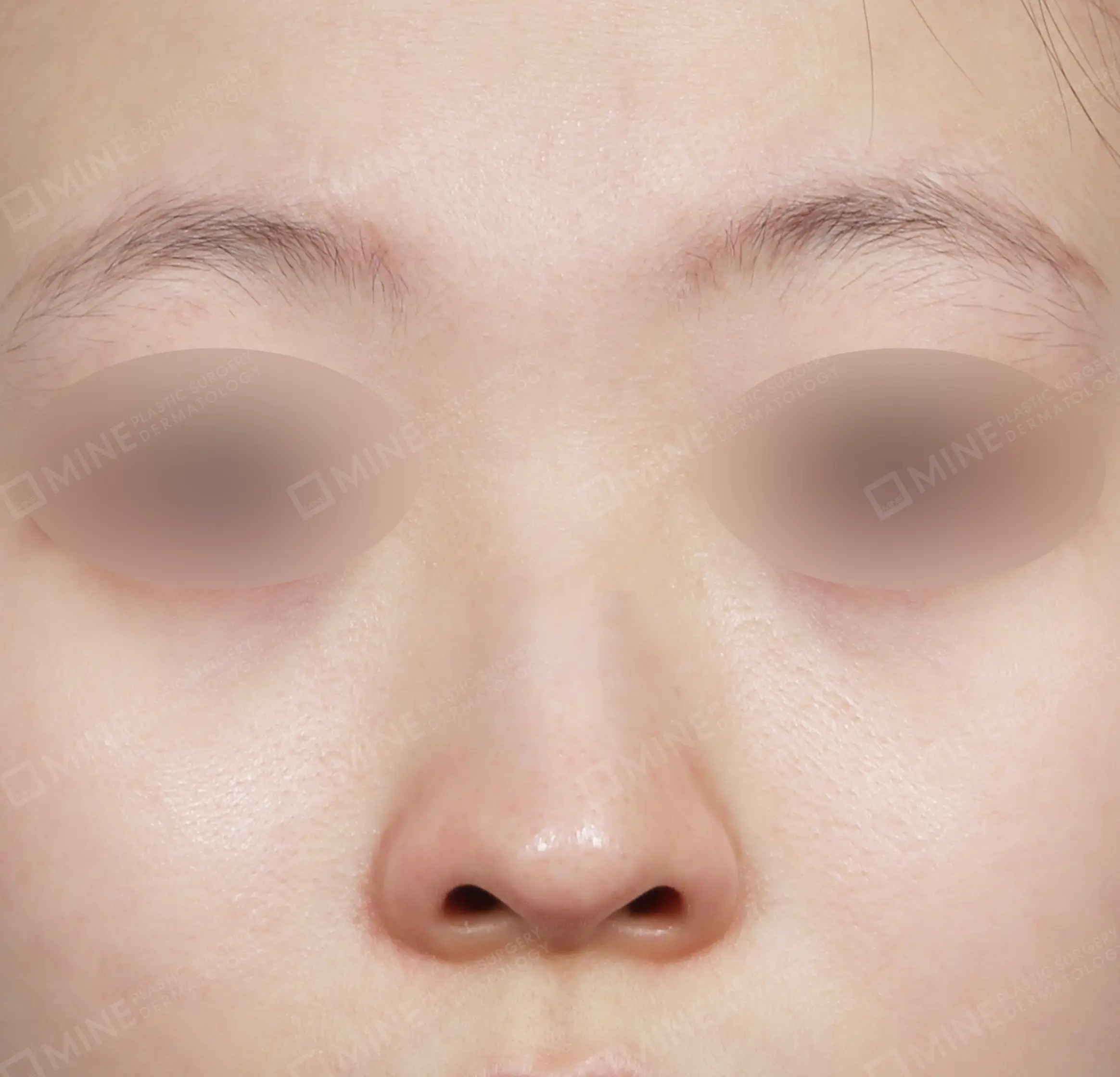 Hidung Punuk + Koreksi Hidung Miring + Batang Hidung + Ujung Hidung-Depan-Sebelum