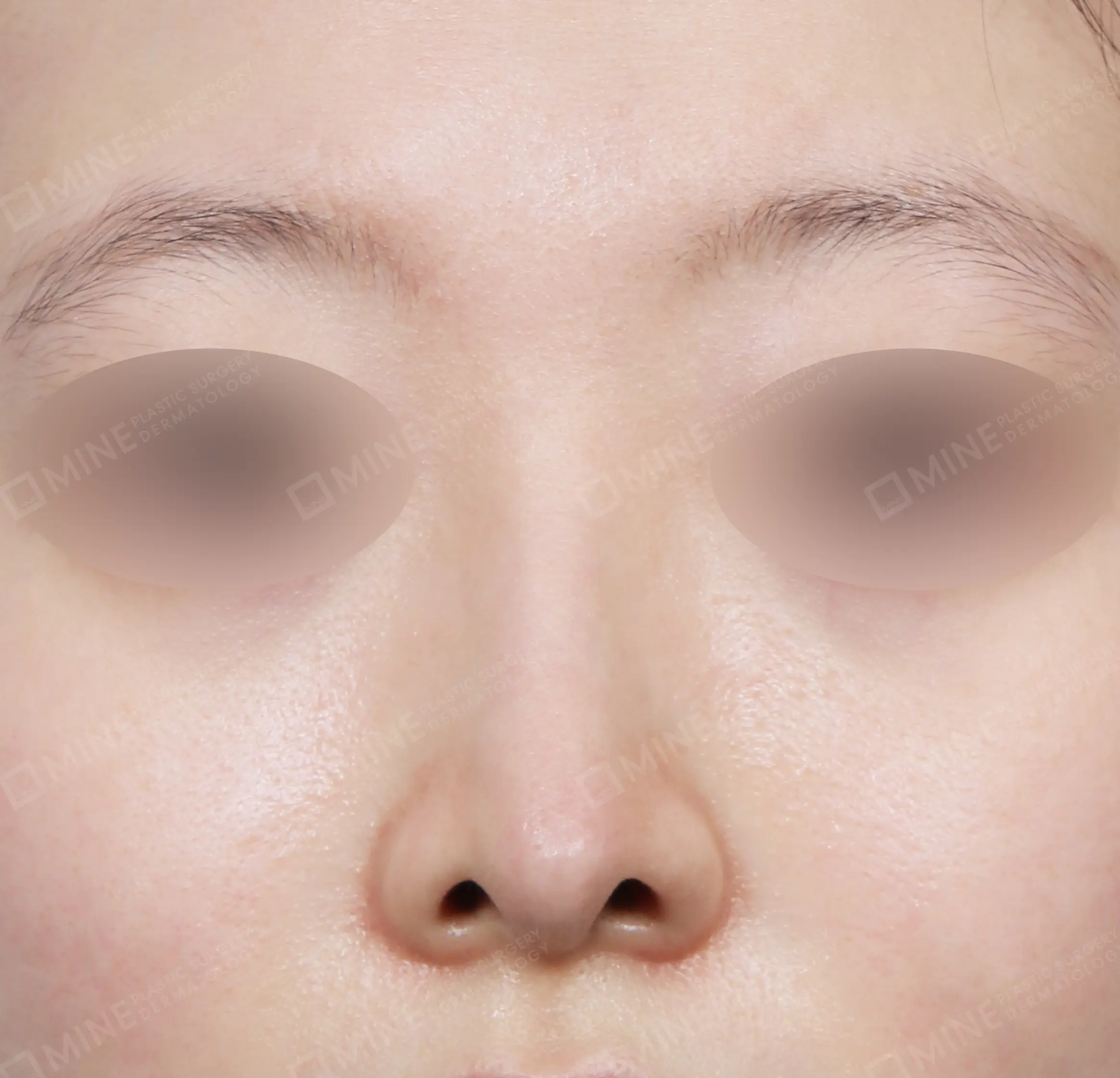 Hidung Punuk + Koreksi Hidung Miring + Batang Hidung + Ujung Hidung-Depan-Sesudah
