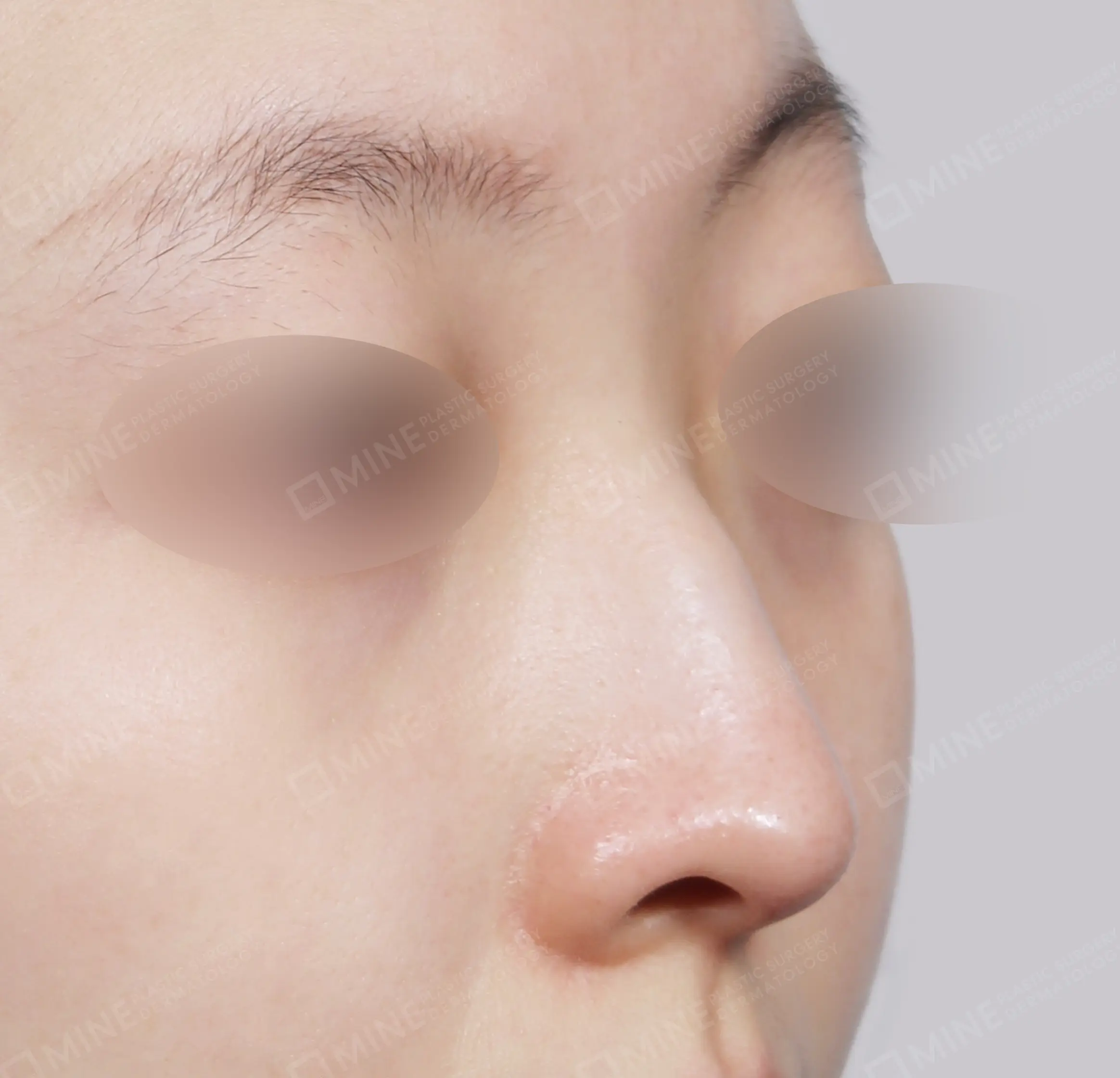 Hidung Punuk + Koreksi Hidung Miring + Batang Hidung + Ujung Hidung-45 Derajat-Sebelum