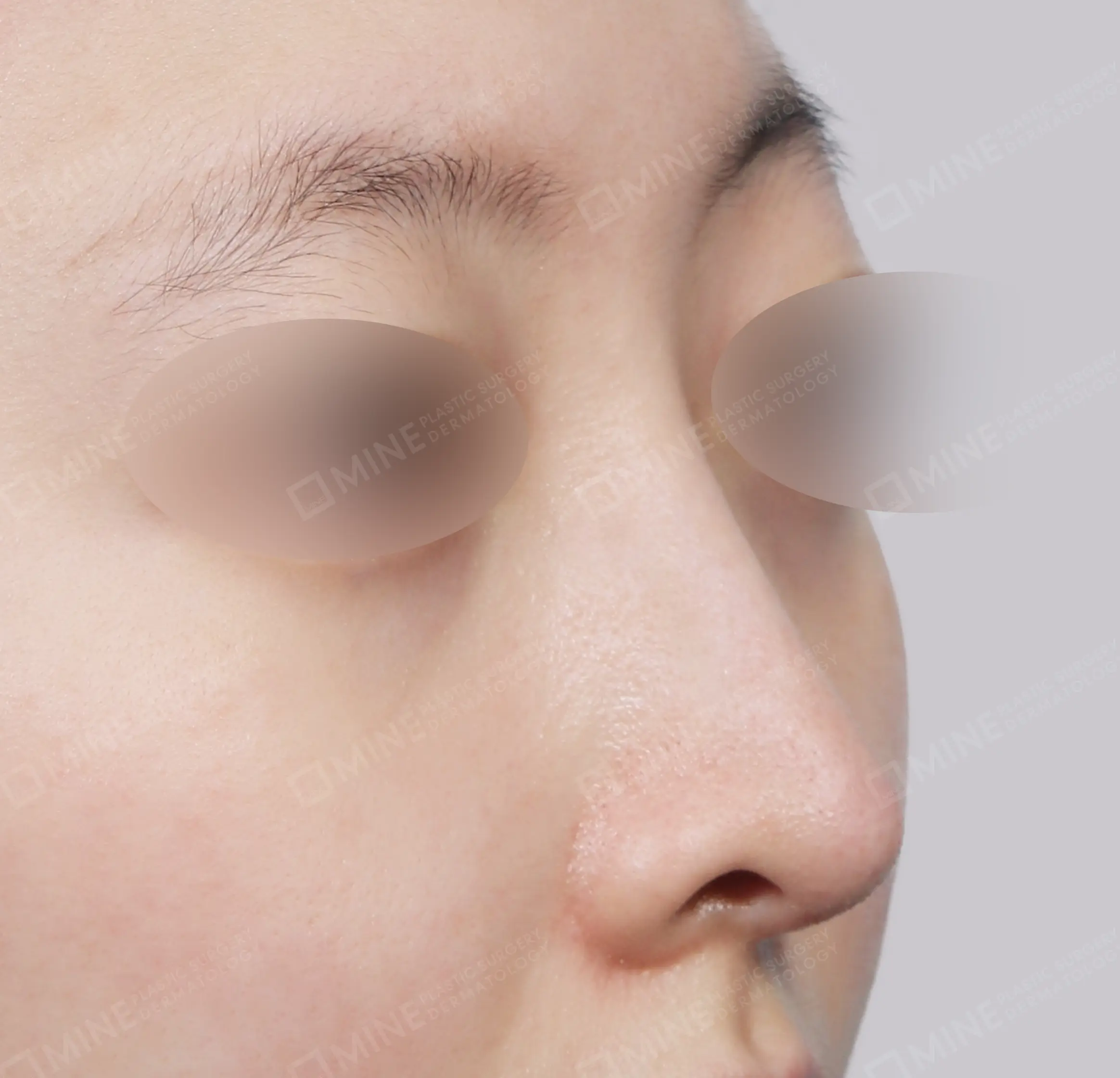 Hidung Punuk + Koreksi Hidung Miring + Batang Hidung + Ujung Hidung-45 Derajat-Sesudah