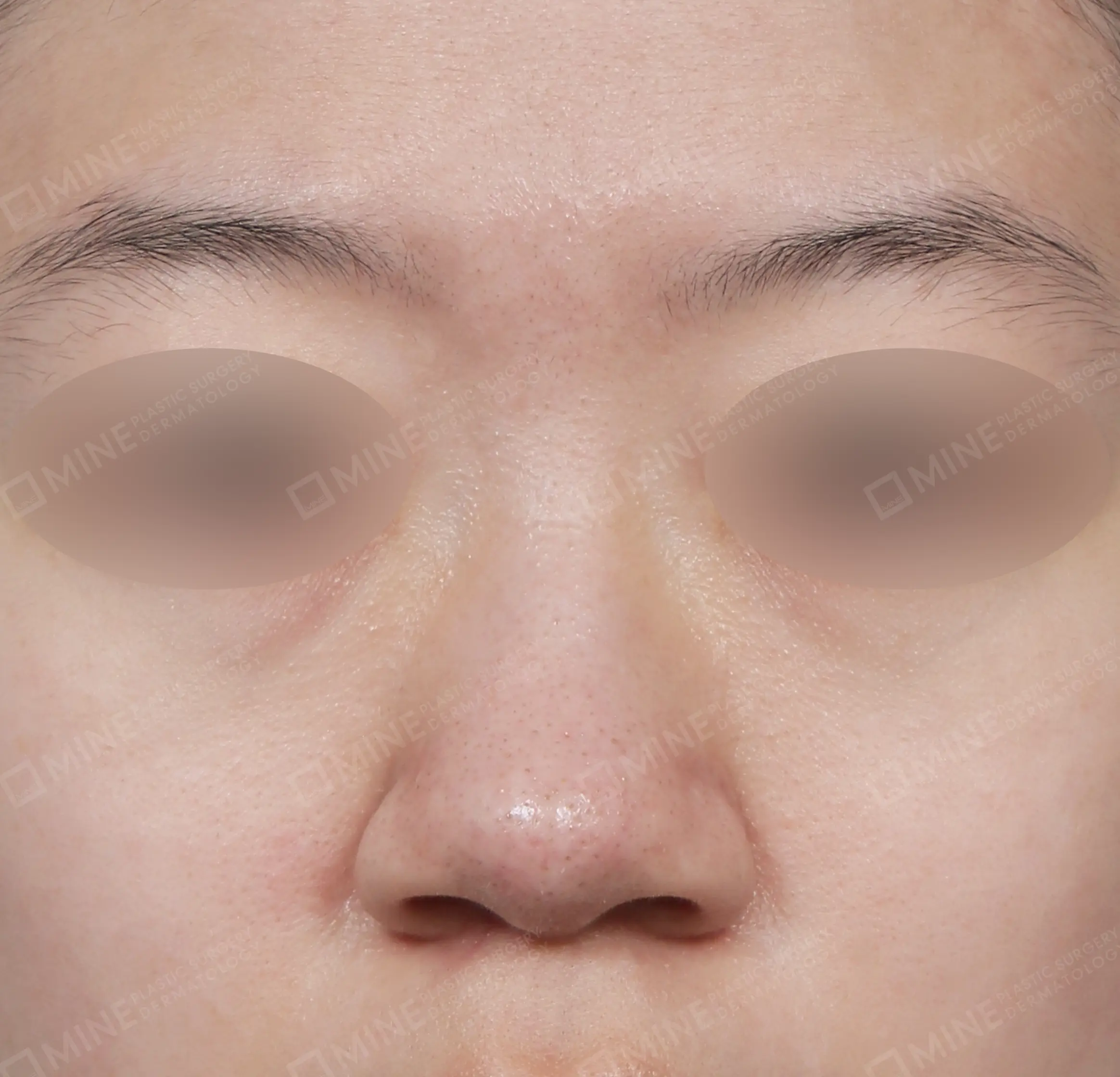Batang Hidung + Pengurangan Ujung Hidung + Pengecilan Lubang Hidung-Depan-Sebelum