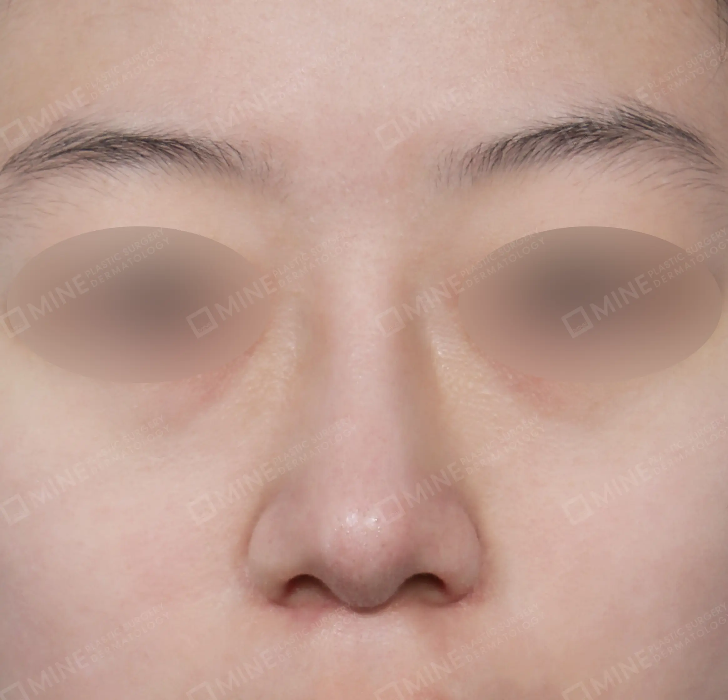 Batang Hidung + Pengurangan Ujung Hidung + Pengecilan Lubang Hidung-Depan-Sesudah