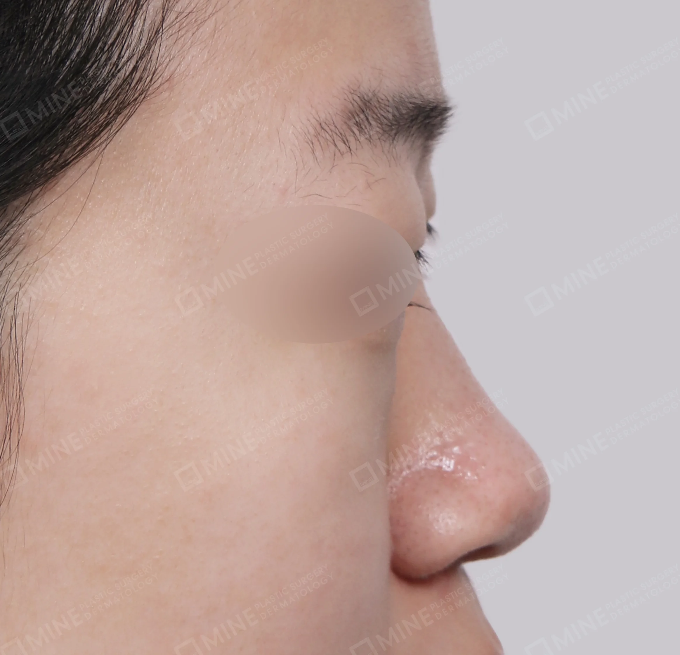 Batang Hidung + Pengurangan Ujung Hidung + Pengecilan Lubang Hidung-Samping-Sebelum