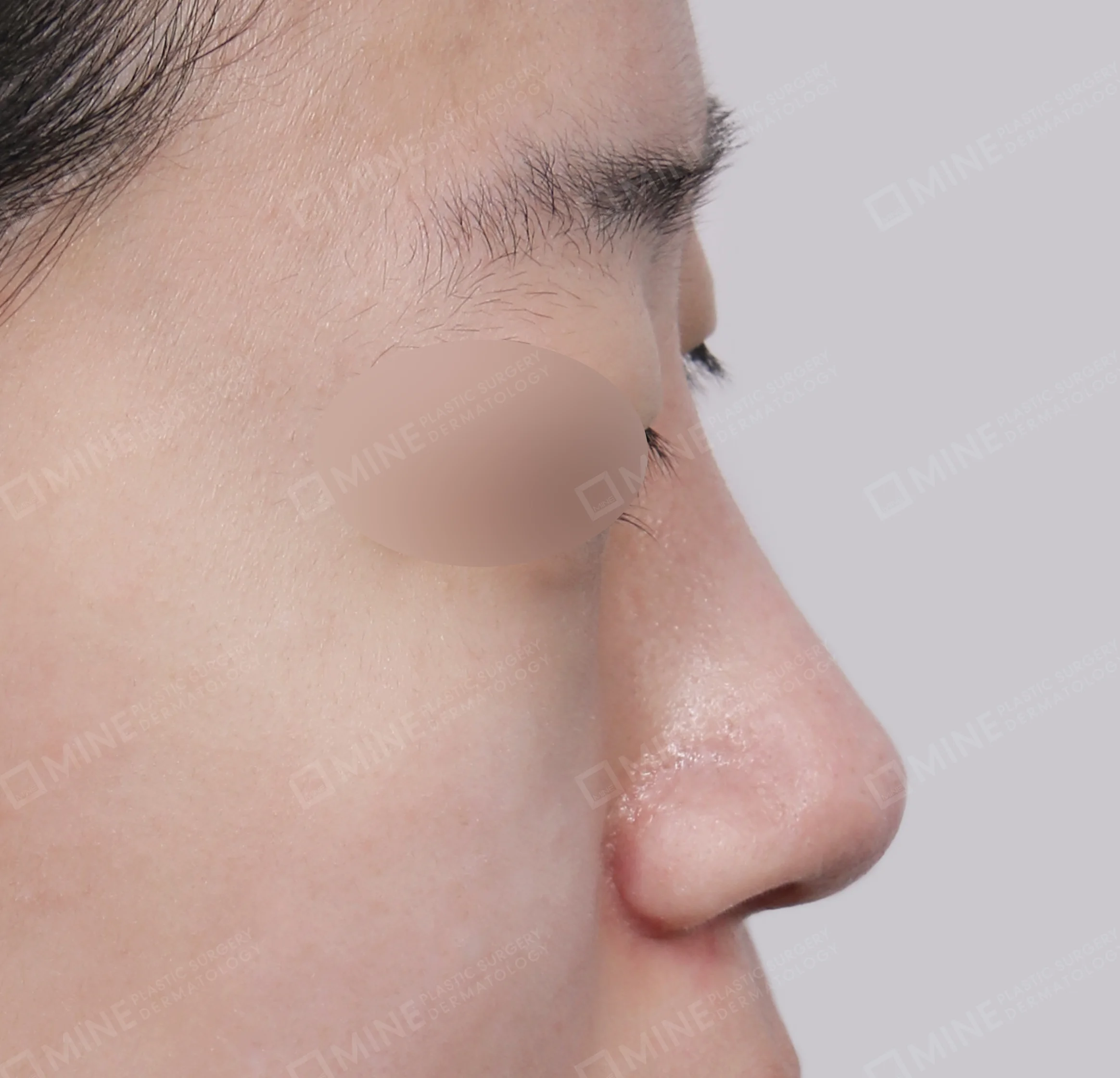 Batang Hidung + Pengurangan Ujung Hidung + Pengecilan Lubang Hidung-Samping-Sesudah