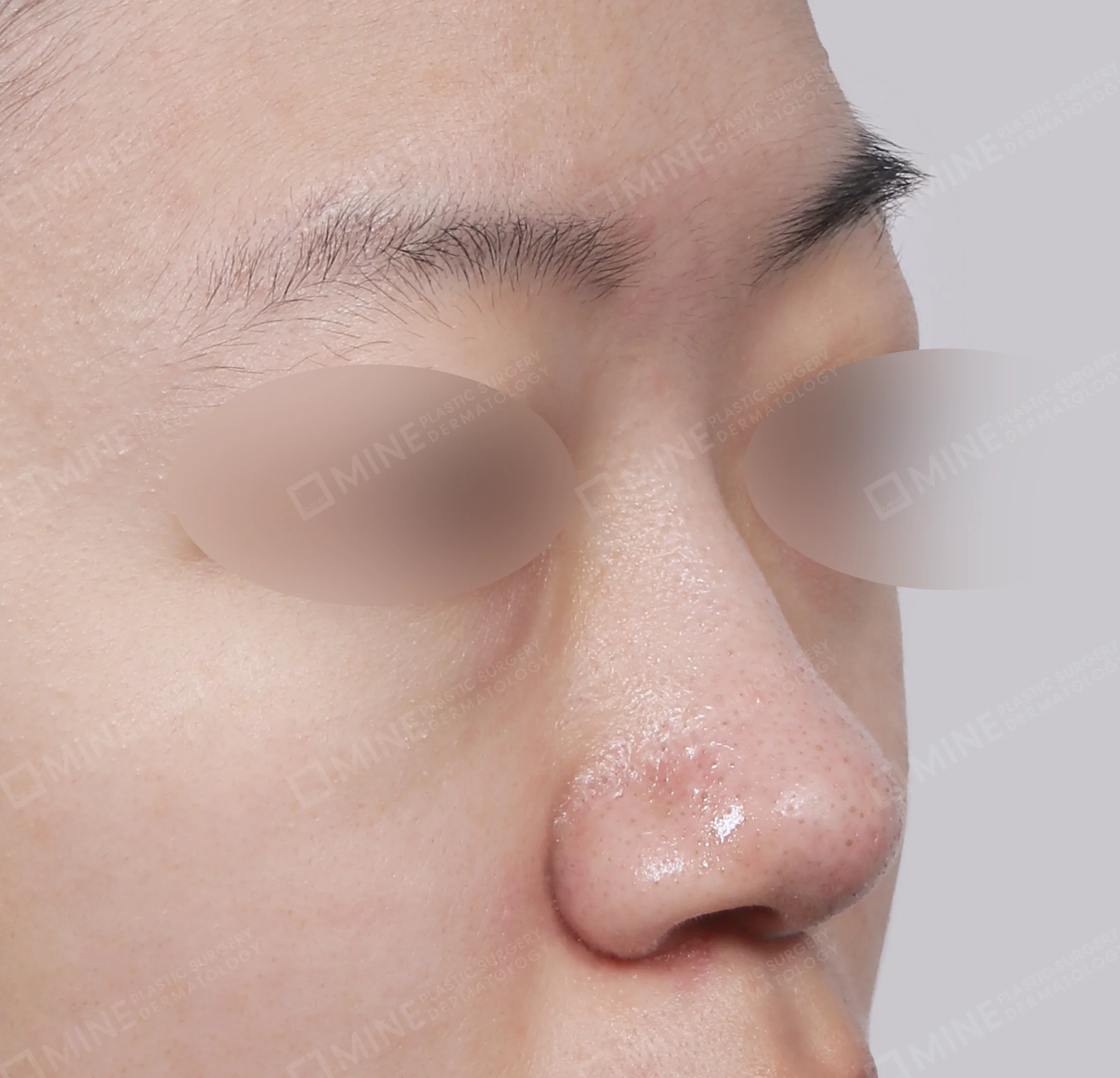 Batang Hidung + Pengurangan Ujung Hidung + Pengecilan Lubang Hidung-45 Derajat-Sebelum