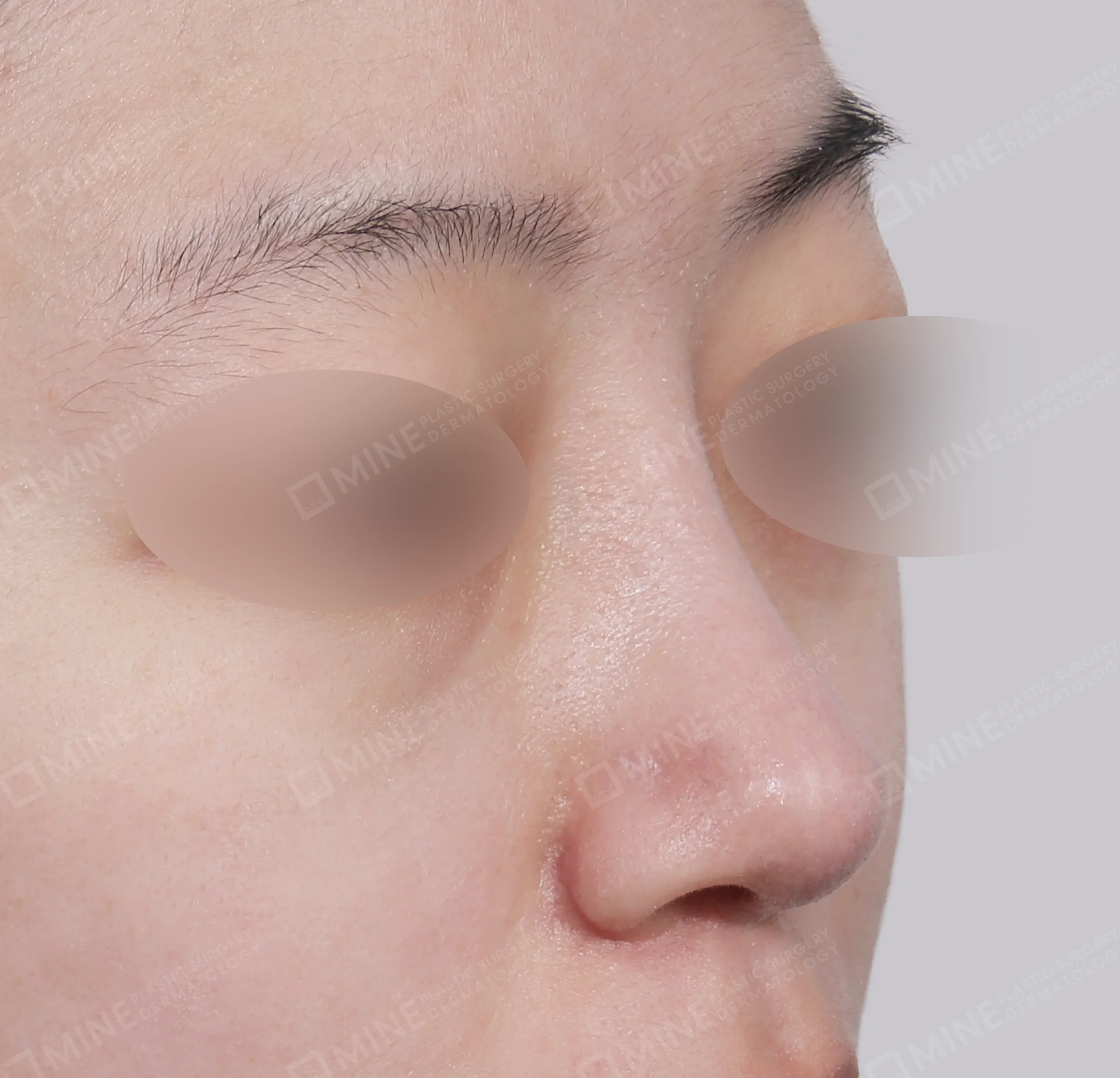 Batang Hidung + Pengurangan Ujung Hidung + Pengecilan Lubang Hidung-45 Derajat-Sesudah