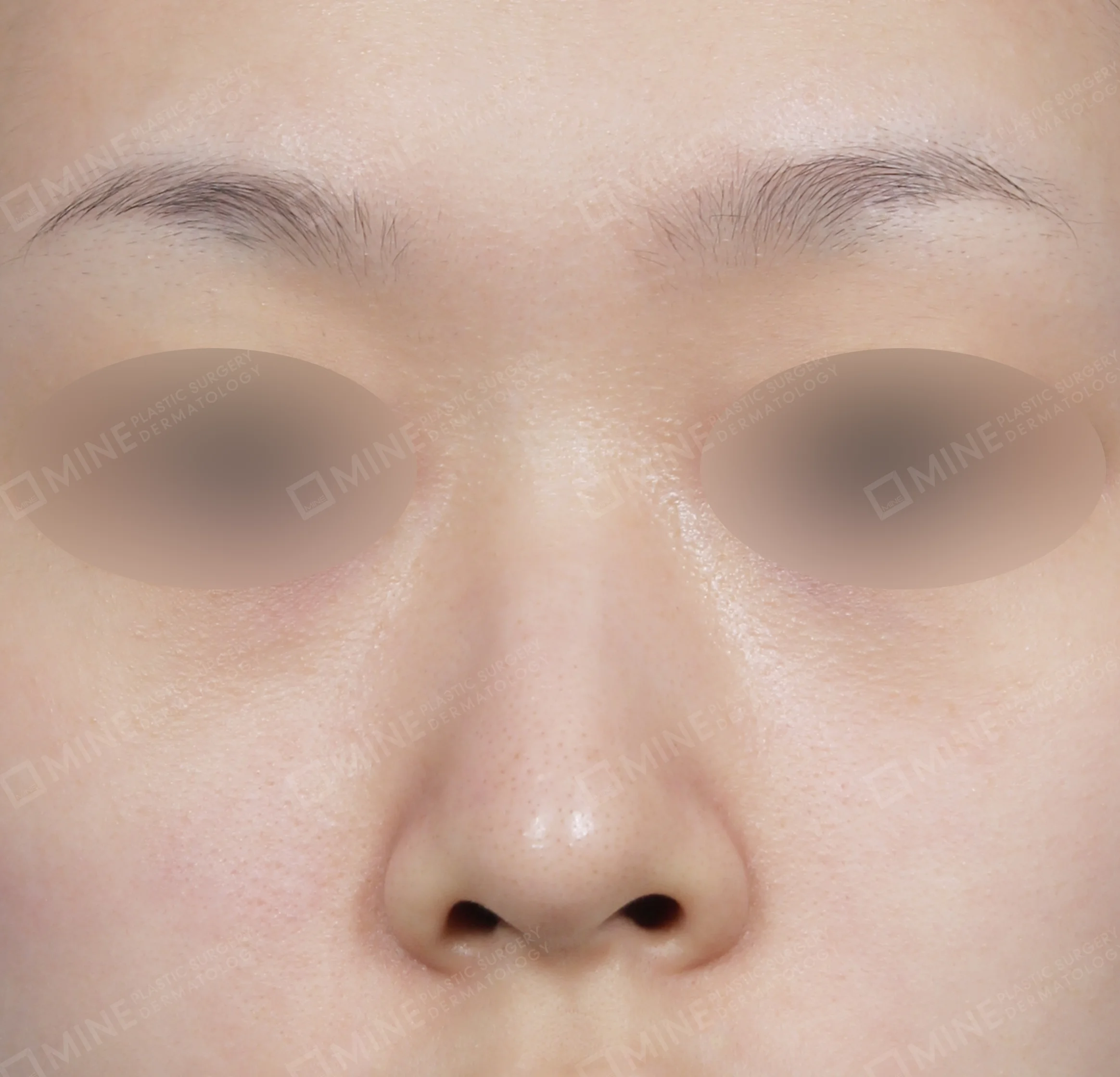 Hidung Punuk + Batang Hidung + Pemanjangan Septum Hidung-Depan-Sebelum