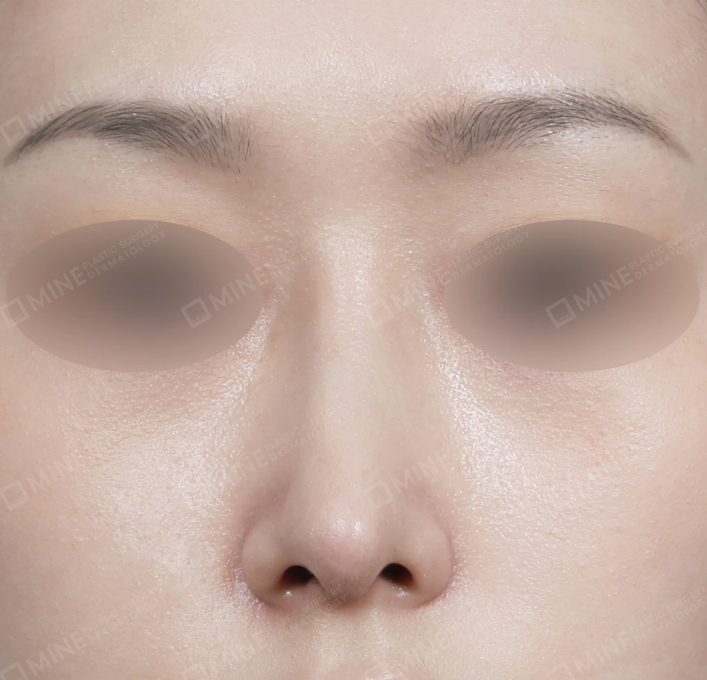 Hidung Punuk + Batang Hidung + Pemanjangan Septum Hidung-Depan-Sesudah