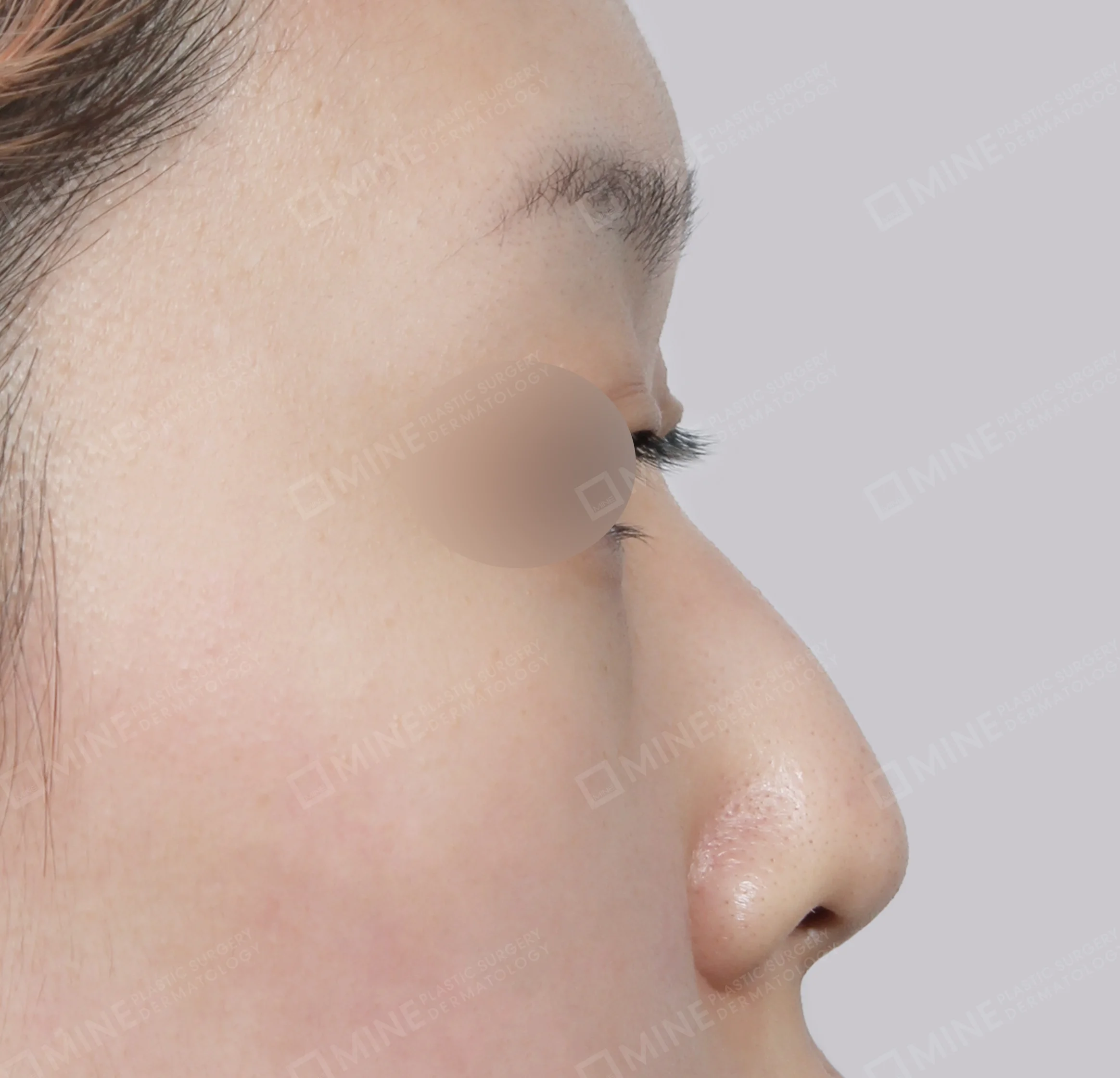 Hidung Punuk + Batang Hidung + Pemanjangan Septum Hidung-Samping-Sebelum