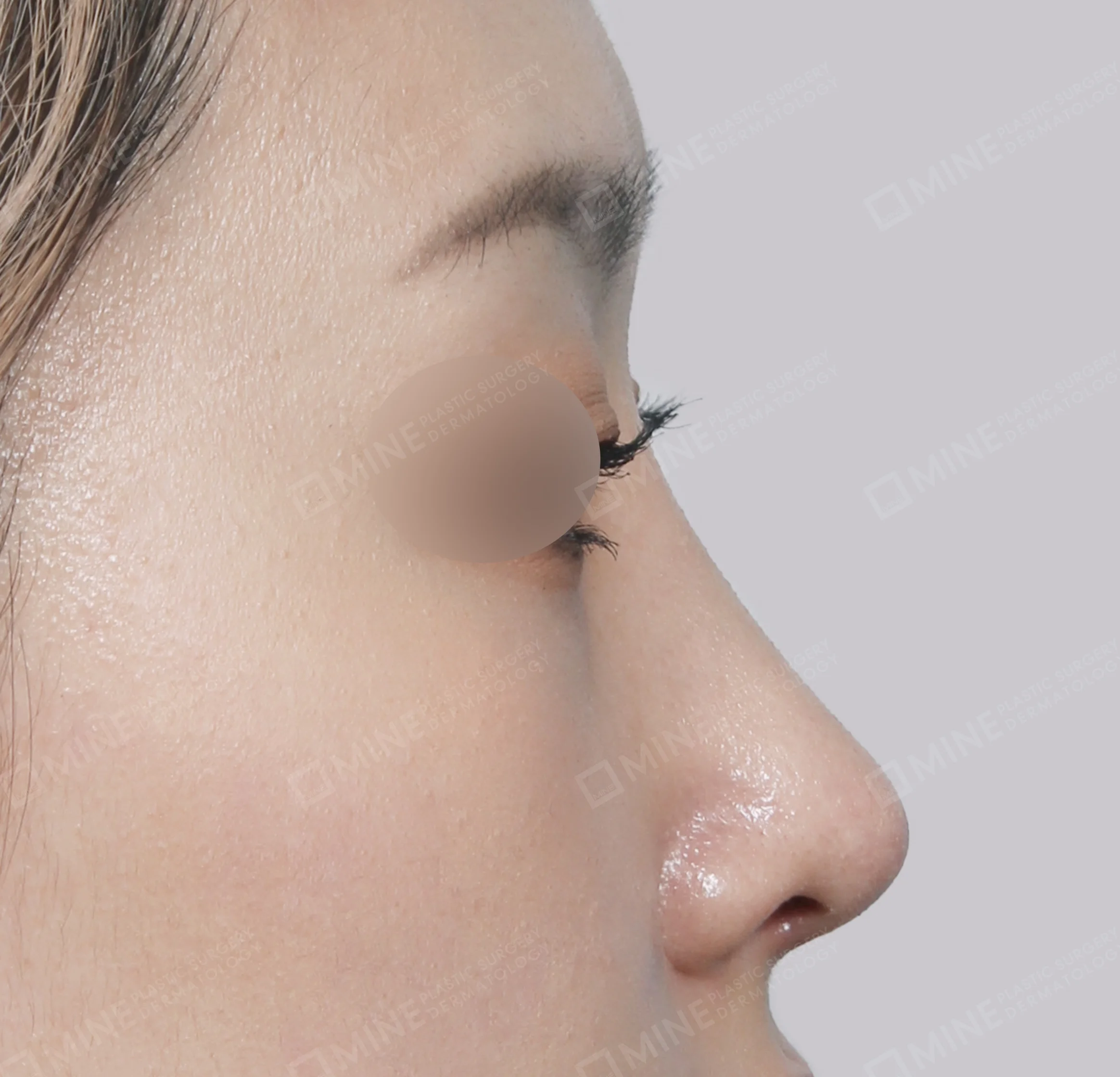 Hidung Punuk + Batang Hidung + Pemanjangan Septum Hidung-Samping-Sesudah