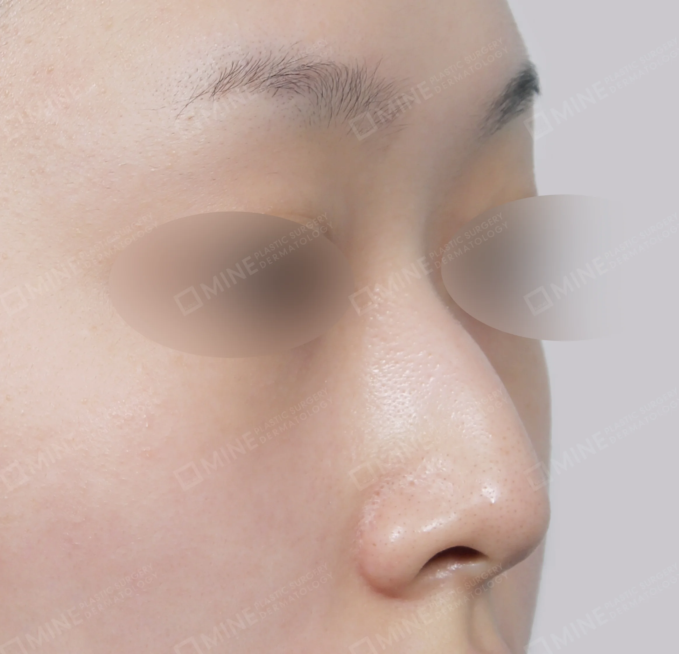 Hidung Punuk + Batang Hidung + Pemanjangan Septum Hidung-45 Derajat-Sebelum