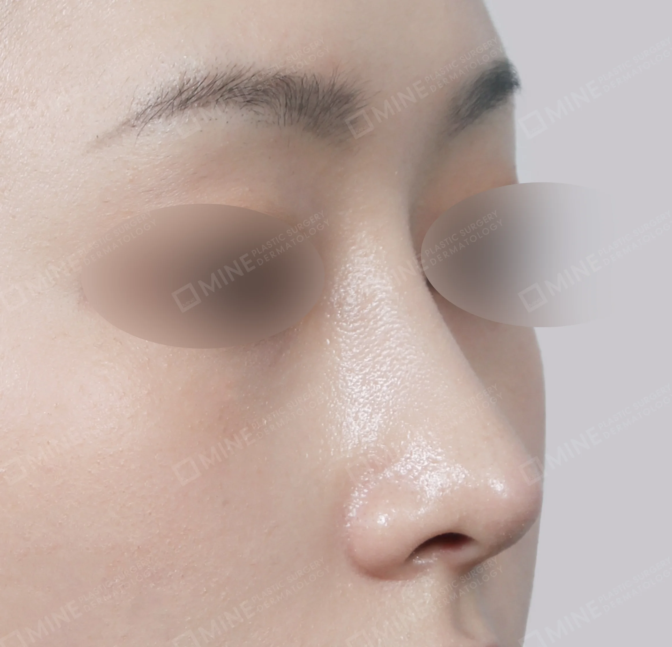 Hidung Punuk + Batang Hidung + Pemanjangan Septum Hidung-45 Derajat-Sesudah