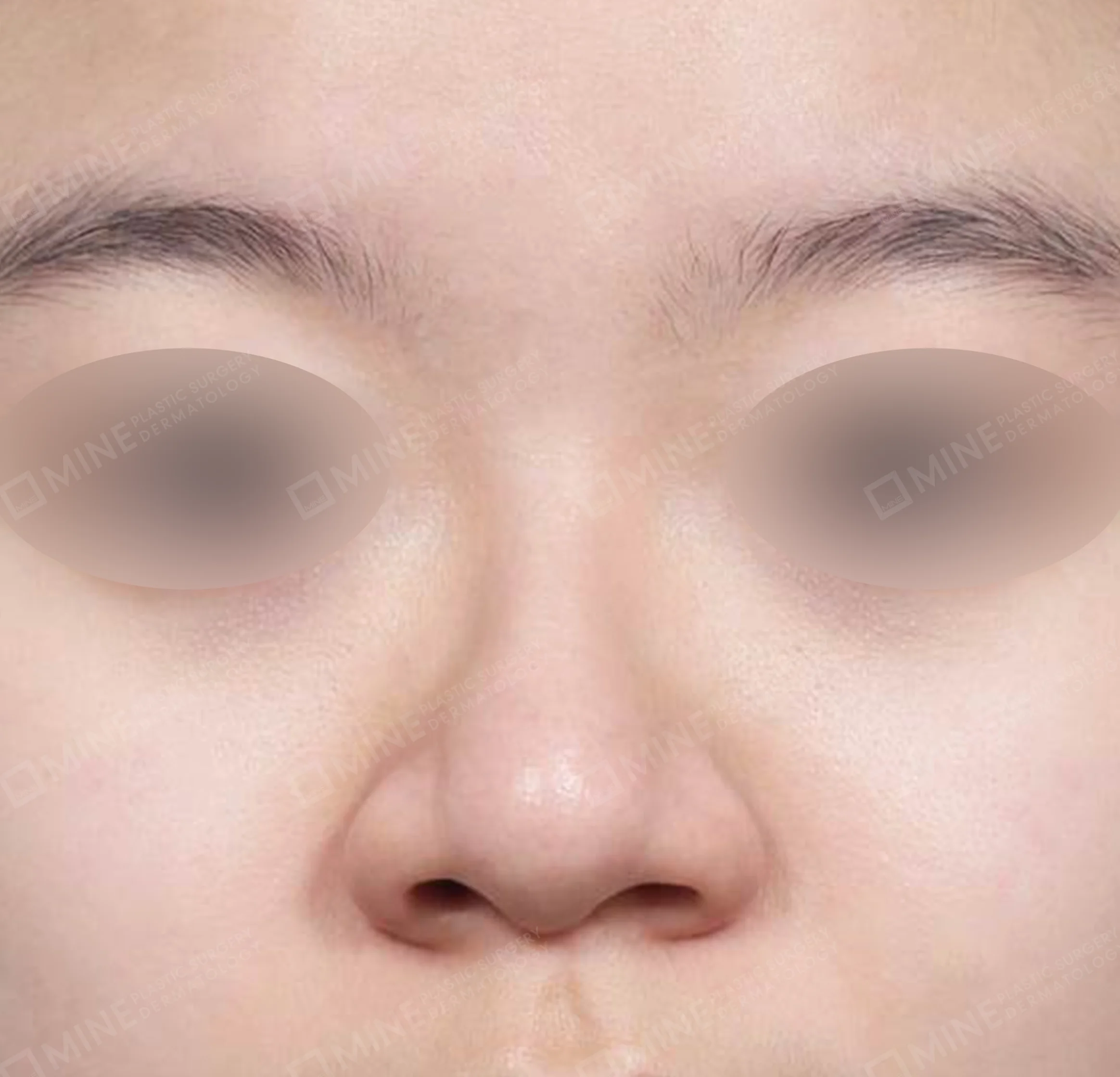 Hidung Punuk + Osteotomi + Pengecilan Lubang Hidung + Batang Hidung-Depan-Sebelum