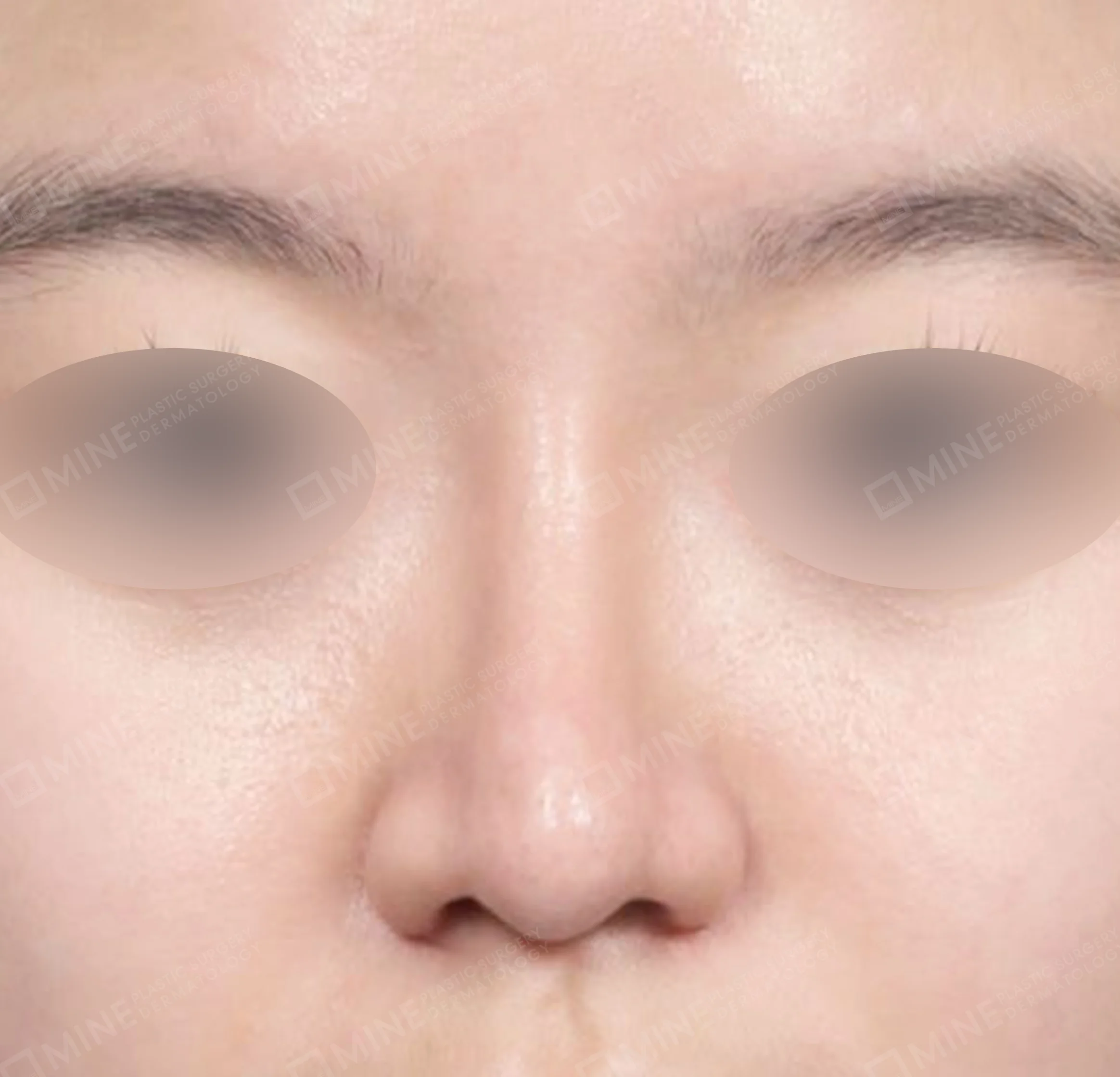 Hidung Punuk + Osteotomi + Pengecilan Lubang Hidung + Batang Hidung-Depan-Sesudah